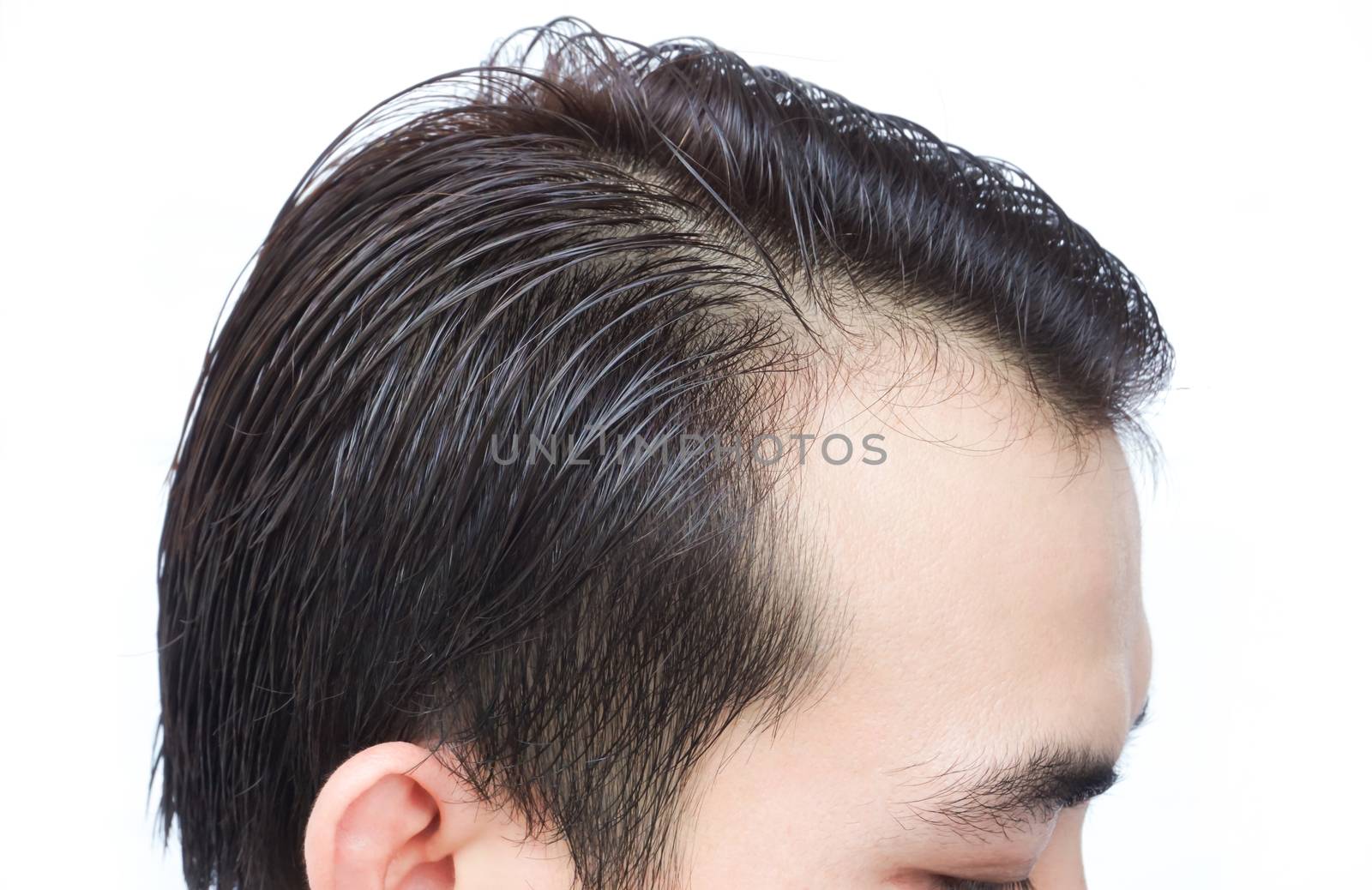 Young man serious hair loss problem for health care shampoo and  by pt.pongsak@gmail.com