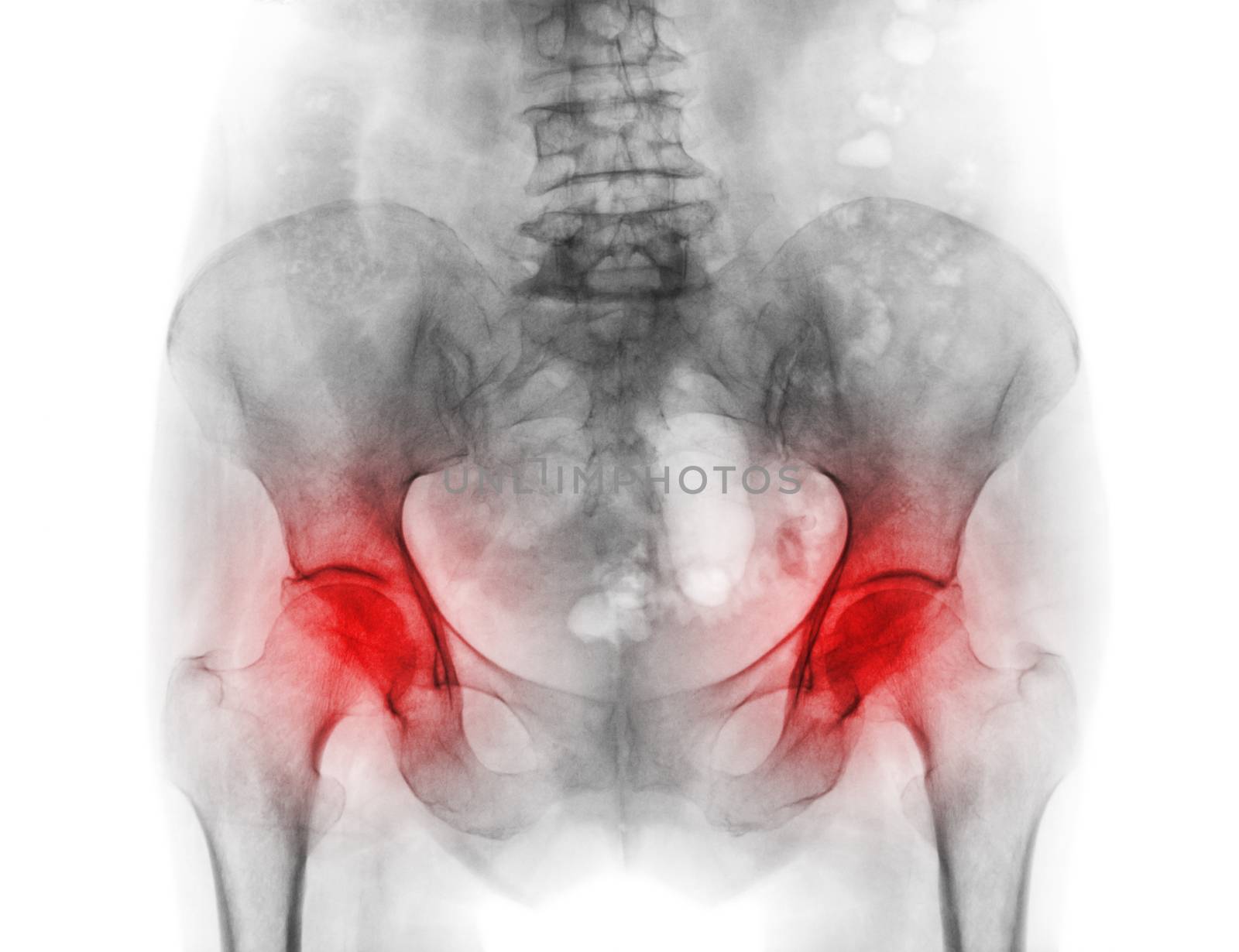 Film x-ray pelvis of osteoporosis patient and arthritis both hip by stockdevil