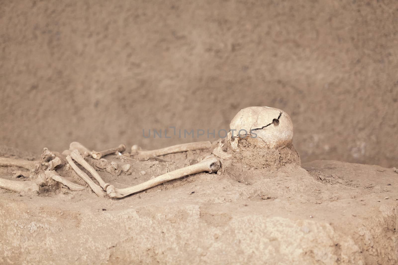 Skeleton. Trepanned skull. by wellphoto