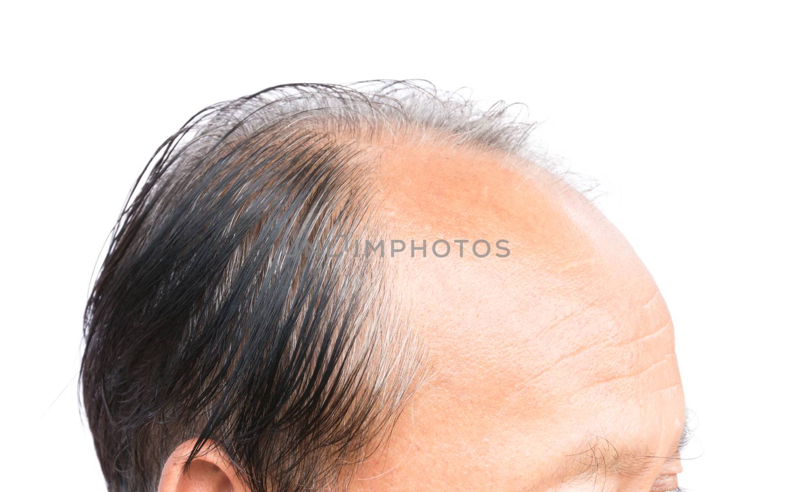 Closeup old man serious hair loss problem and gray for health ca by pt.pongsak@gmail.com