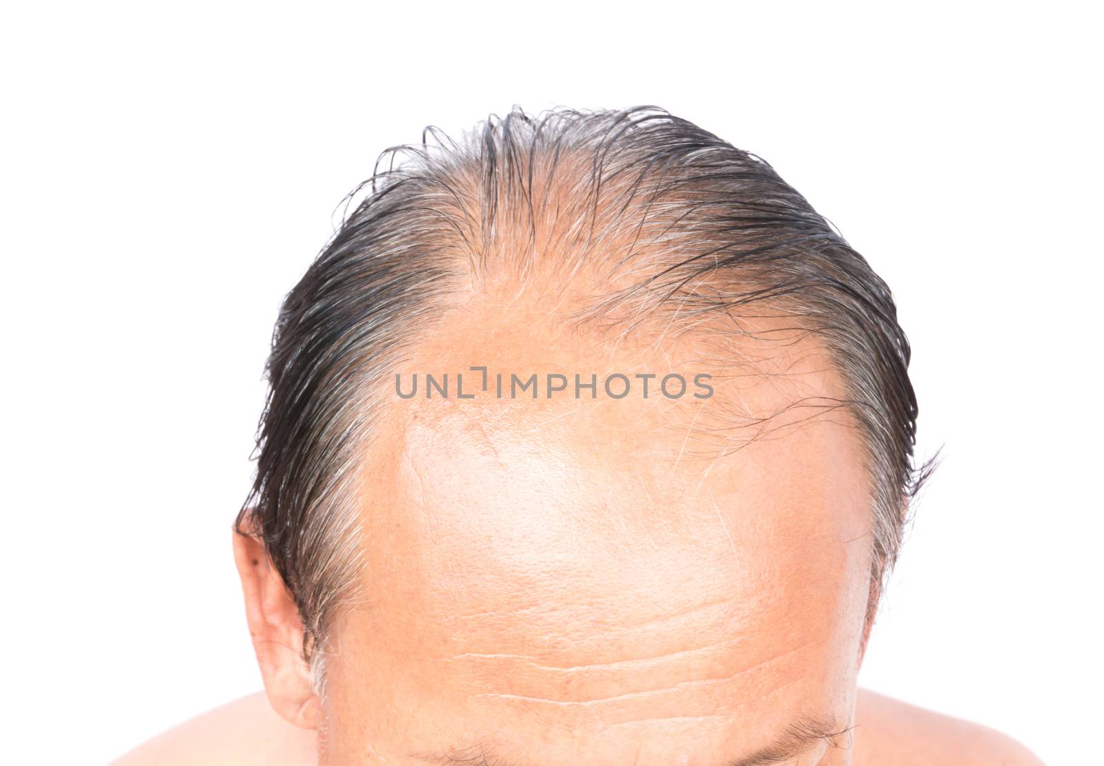 Closeup old man serious hair loss problem and gray for health ca by pt.pongsak@gmail.com