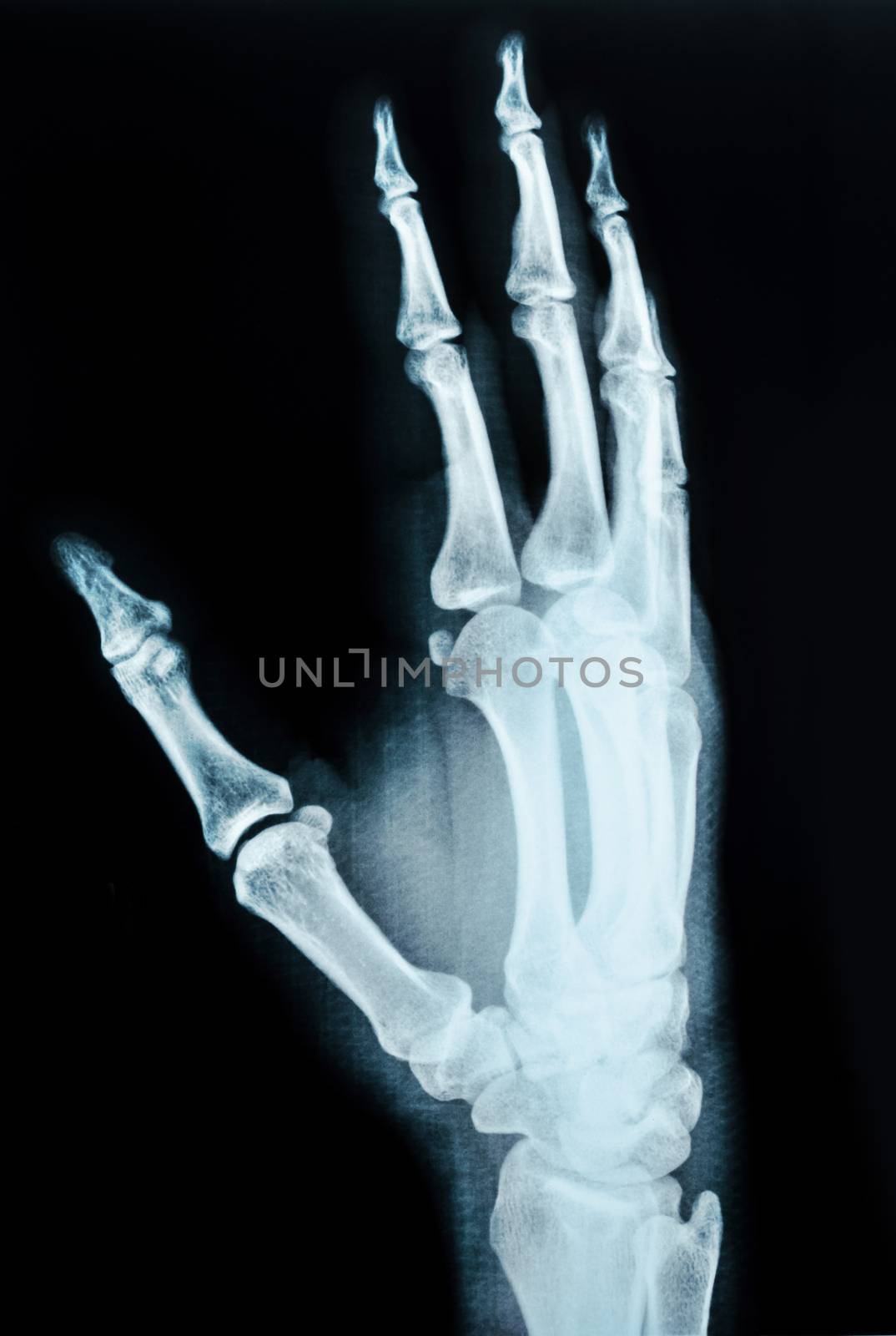 x-ray picture of human hands. by Gamjai