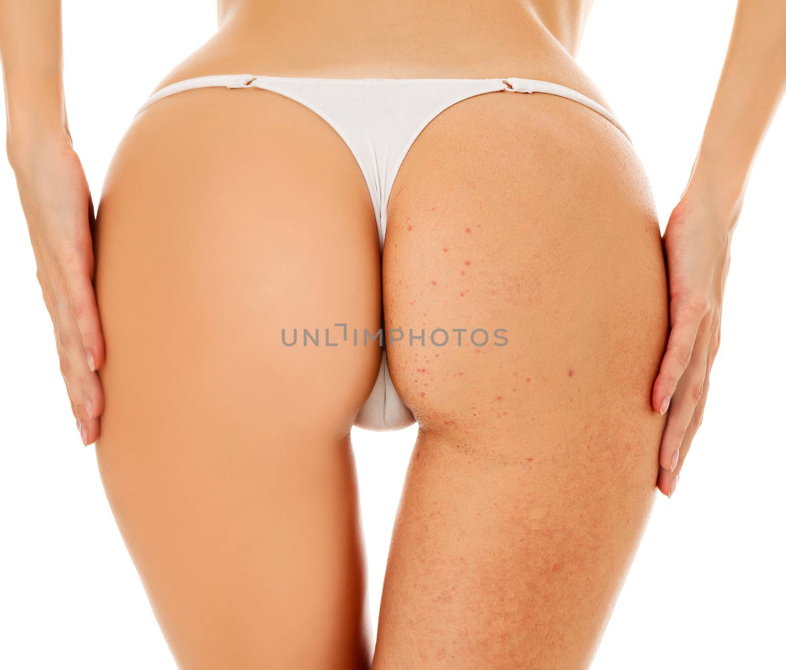 Closeup shot of female buttocks. Before - after concept. Isolated on white background