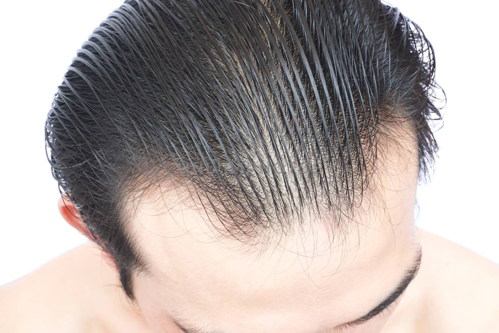 Young man serious hair loss problem for health care medical and shampoo product concept