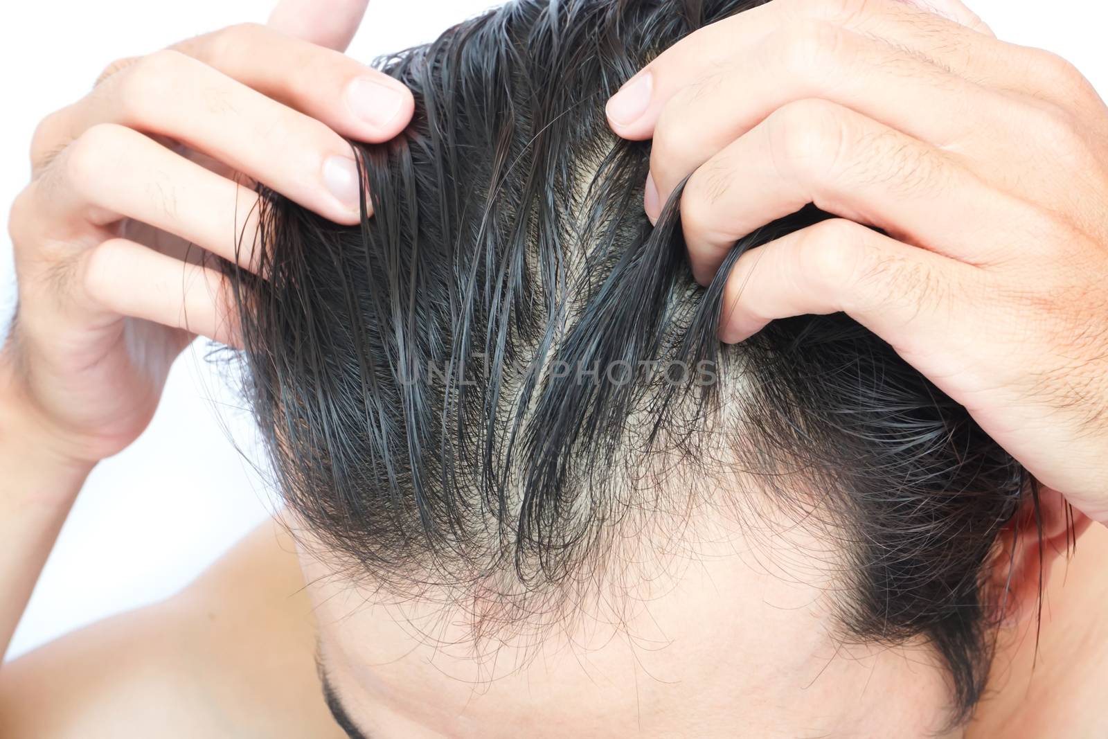 Young man serious hair loss problem for health care medical and  by pt.pongsak@gmail.com