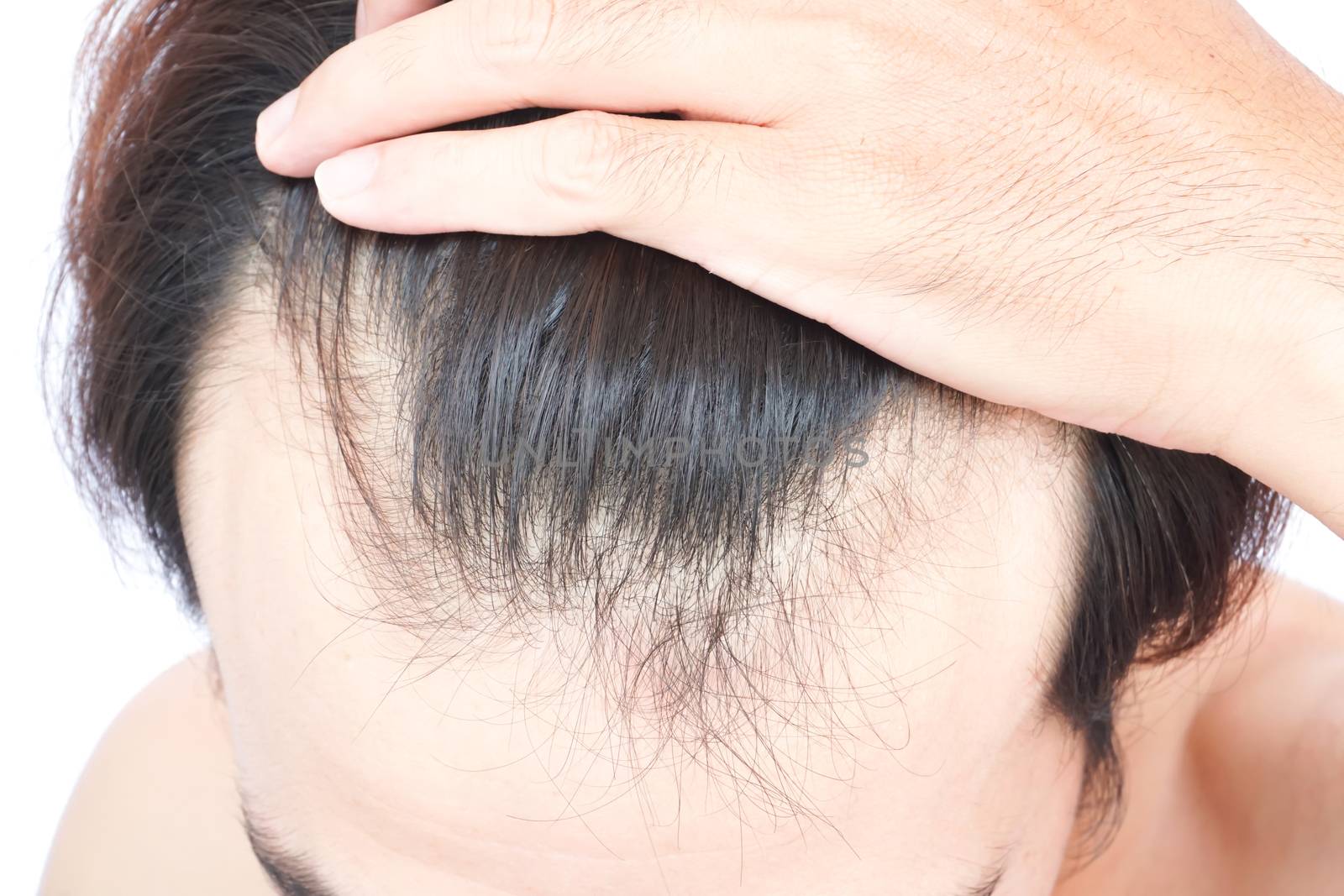 Young man serious hair loss problem for health care medical and shampoo product concept