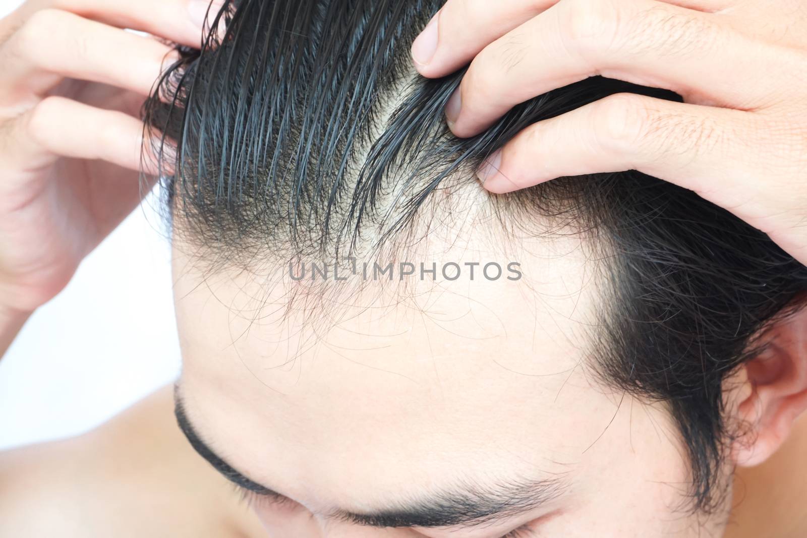 Young man serious hair loss problem for health care medical and  by pt.pongsak@gmail.com