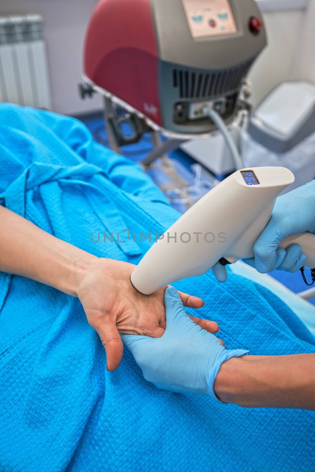 Procedure for palm against hyperhidrosis