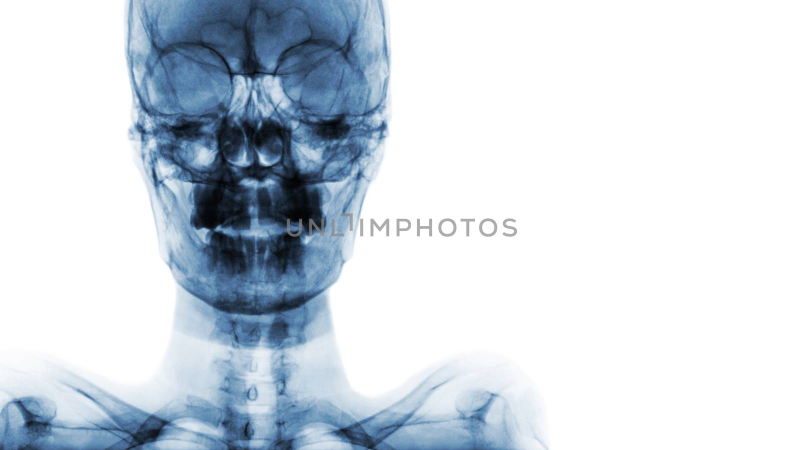 film x-ray Skull AP : show normal human's skull and blank area at right side by stockdevil