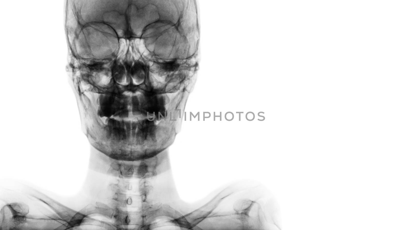 film x-ray Skull AP : show normal human's skull and blank area at right side .