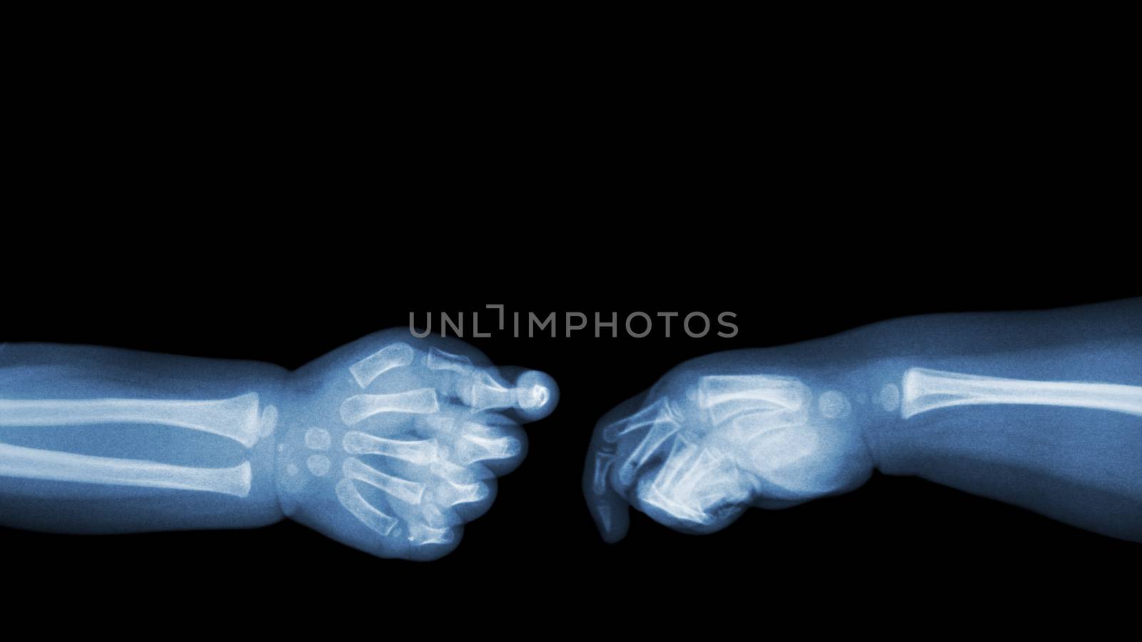 Baby 's hands x-ray and blank area at upper side . ( Shake hands ) . Isolated .
