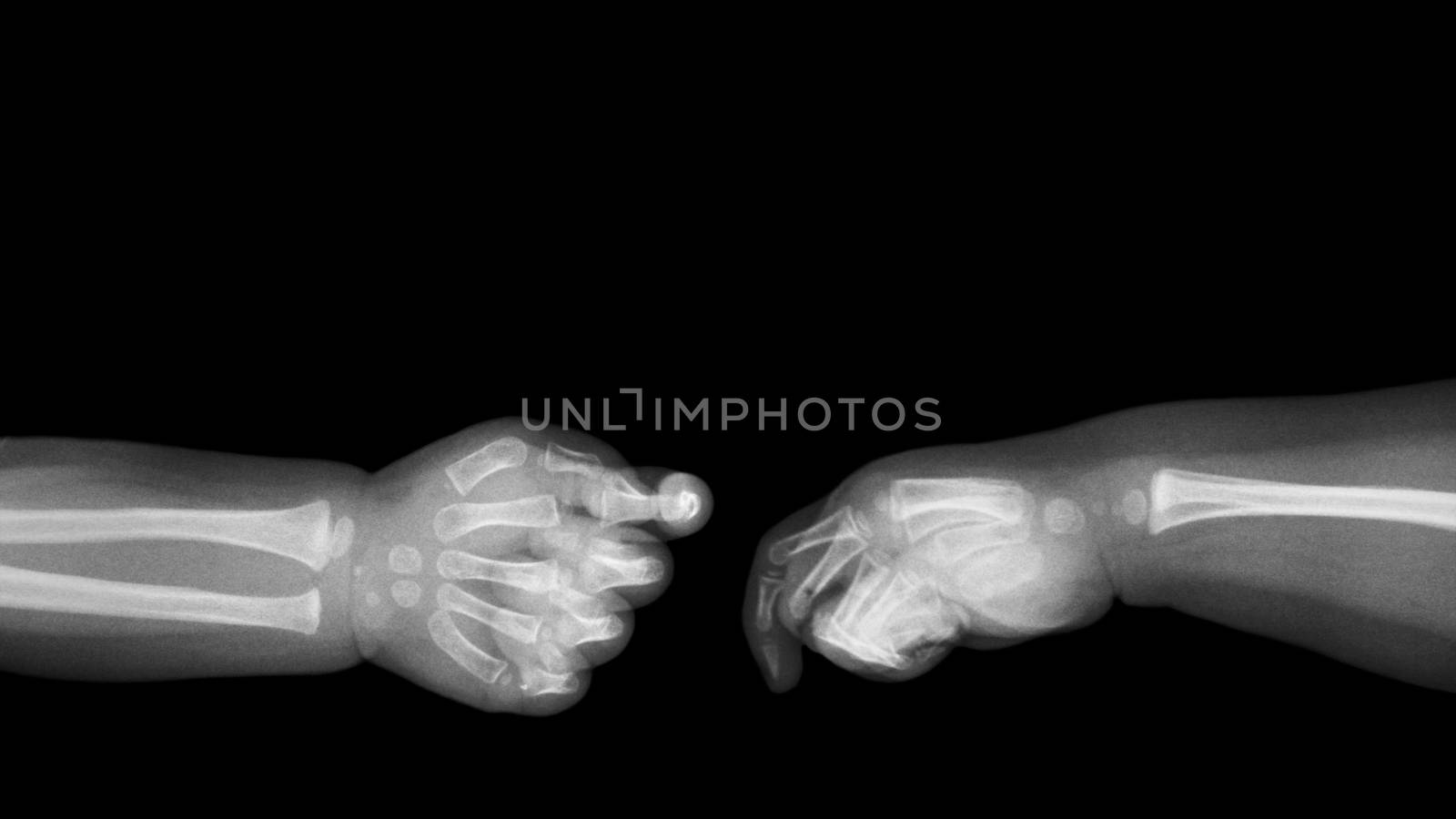 Baby 's hands x-ray and blank area at upper side . ( Shake hands ) . Isolated by stockdevil