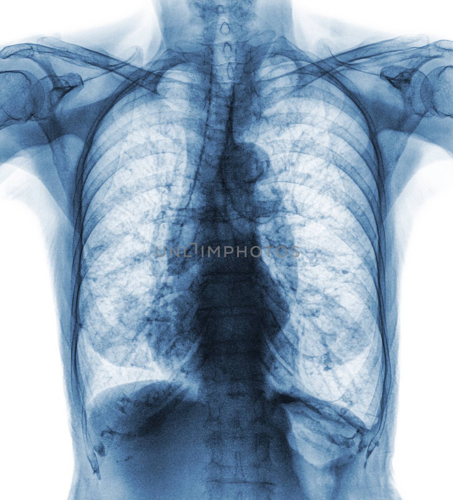 Normal chest X-ray of old patient . You can seen calcification at rib , trachea , bronchus . Front view .