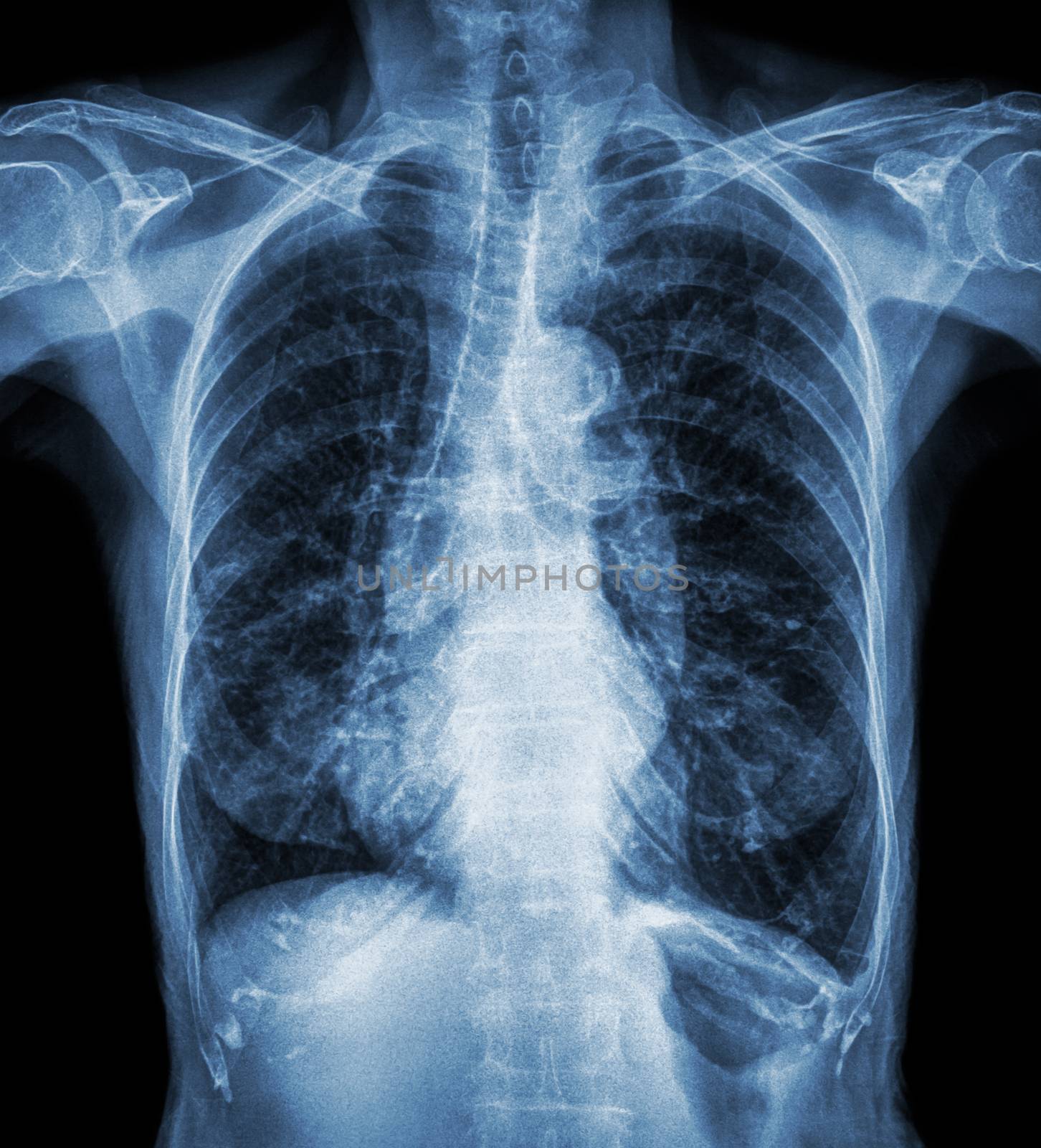 Normal chest X-ray of old patient . You can seen calcification at rib , trachea , bronchus . Front view .