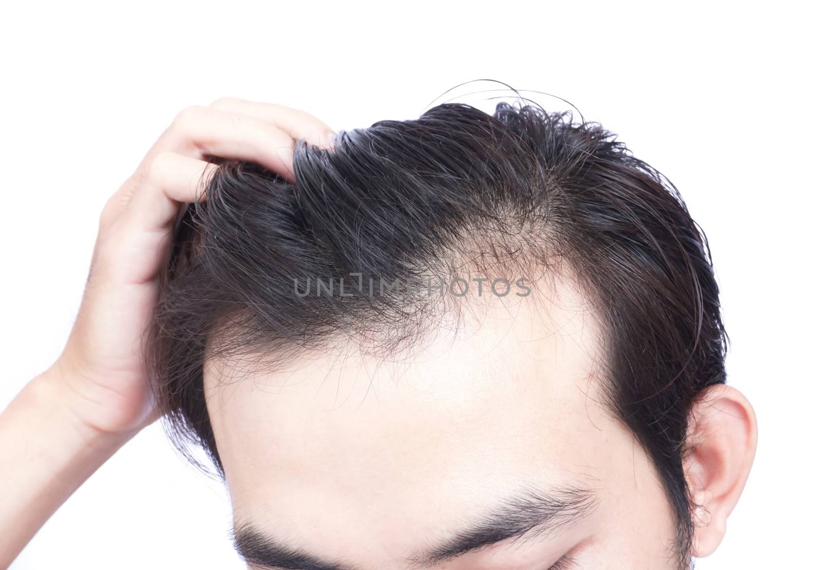 Young man serious hair loss problem for health care medical and shampoo product concept