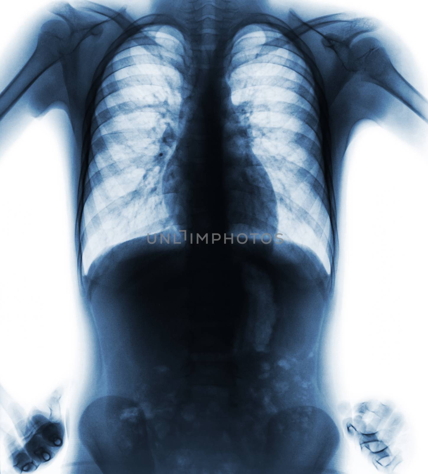Normal film chest x-ray ( akimbo position ) ( front view ) .