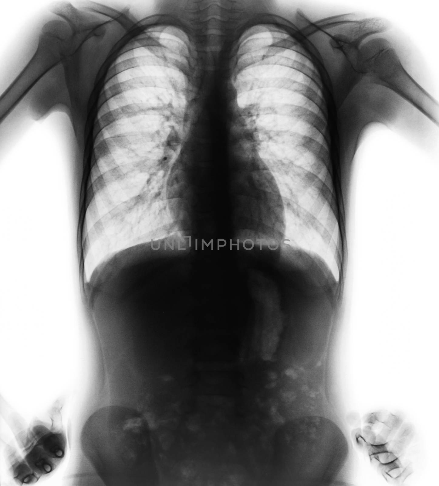 Normal film chest x-ray ( akimbo position ) ( front view ) .
