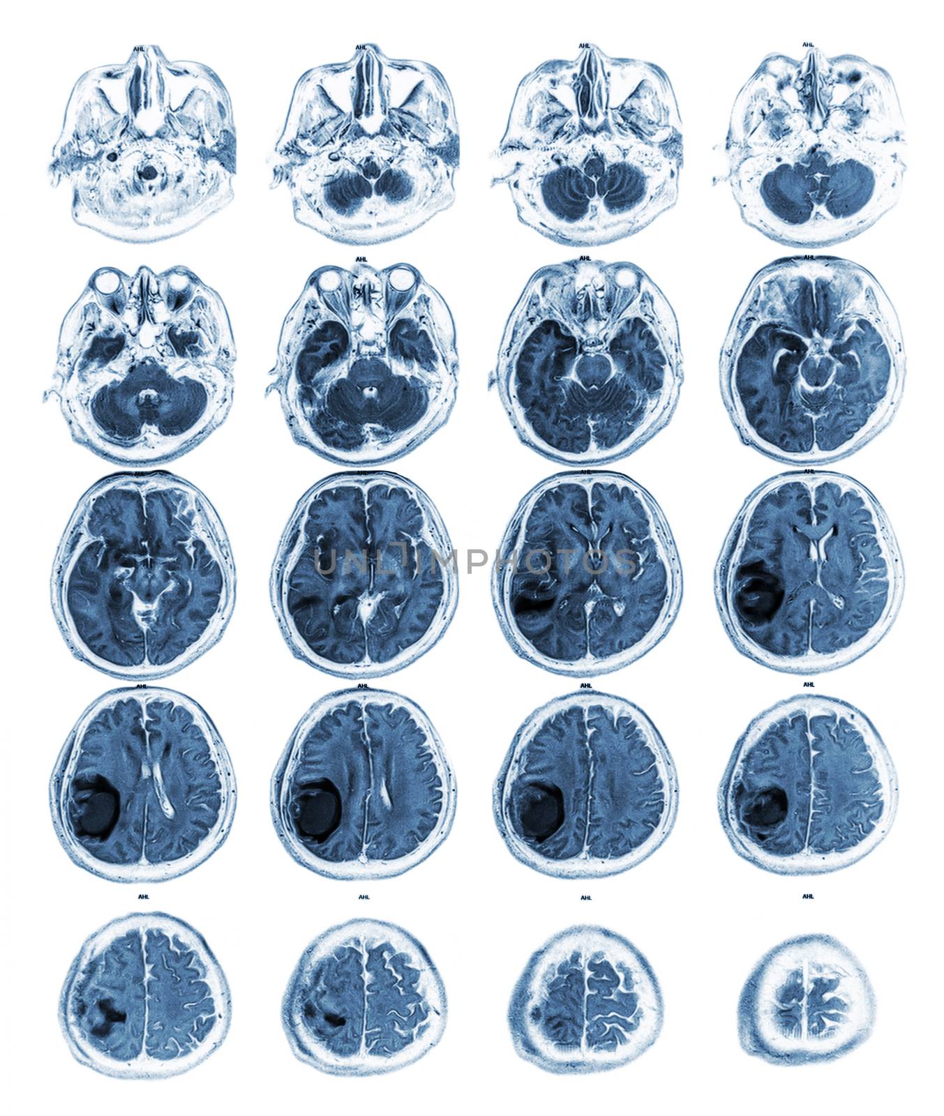 MRI brain show Brain tumor at right parietal lobe by stockdevil
