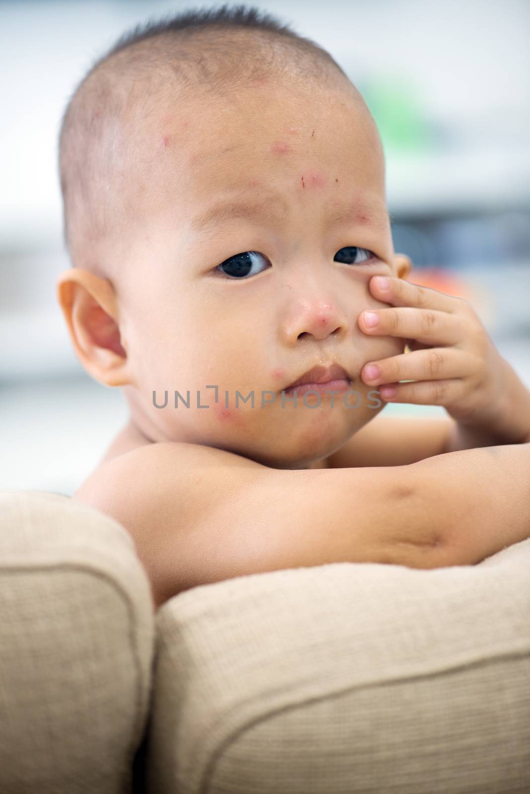 Asian baby sitting on couch with chicken pox rash, natural photo.
