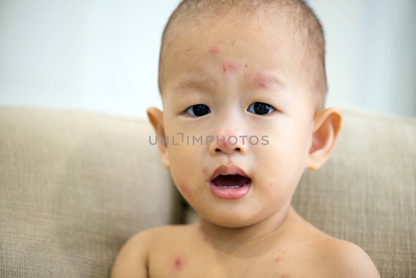 Asian baby sitting on couch with red spots of chickenpox, natural photo.