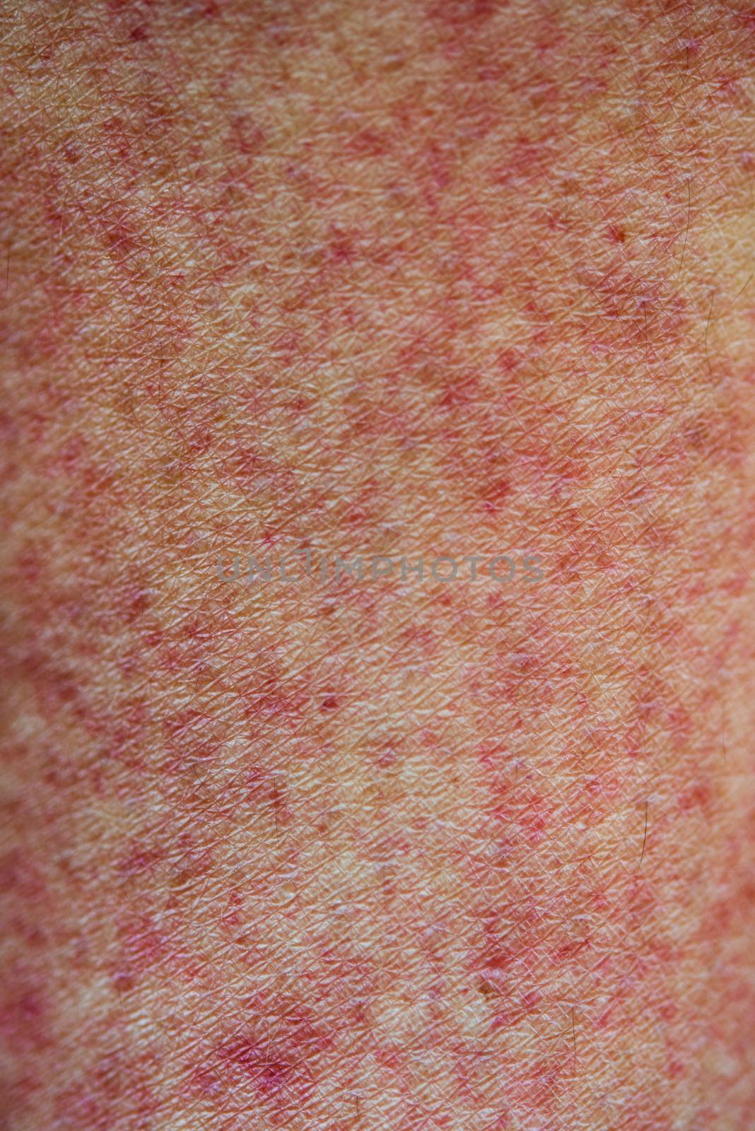 Close up human skin with red rashes, or dengue fever.