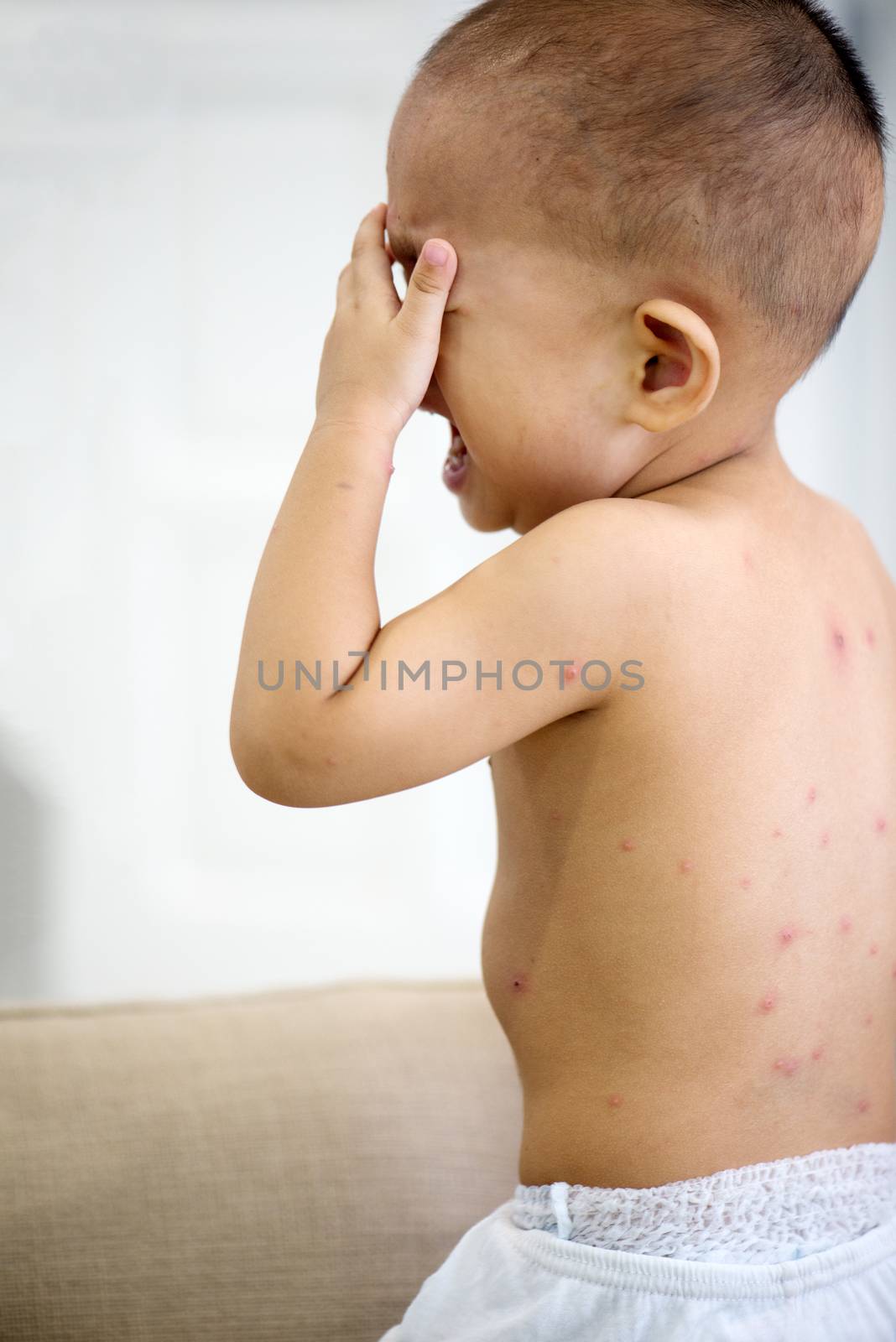 Baby boy with chicken pox crying by szefei