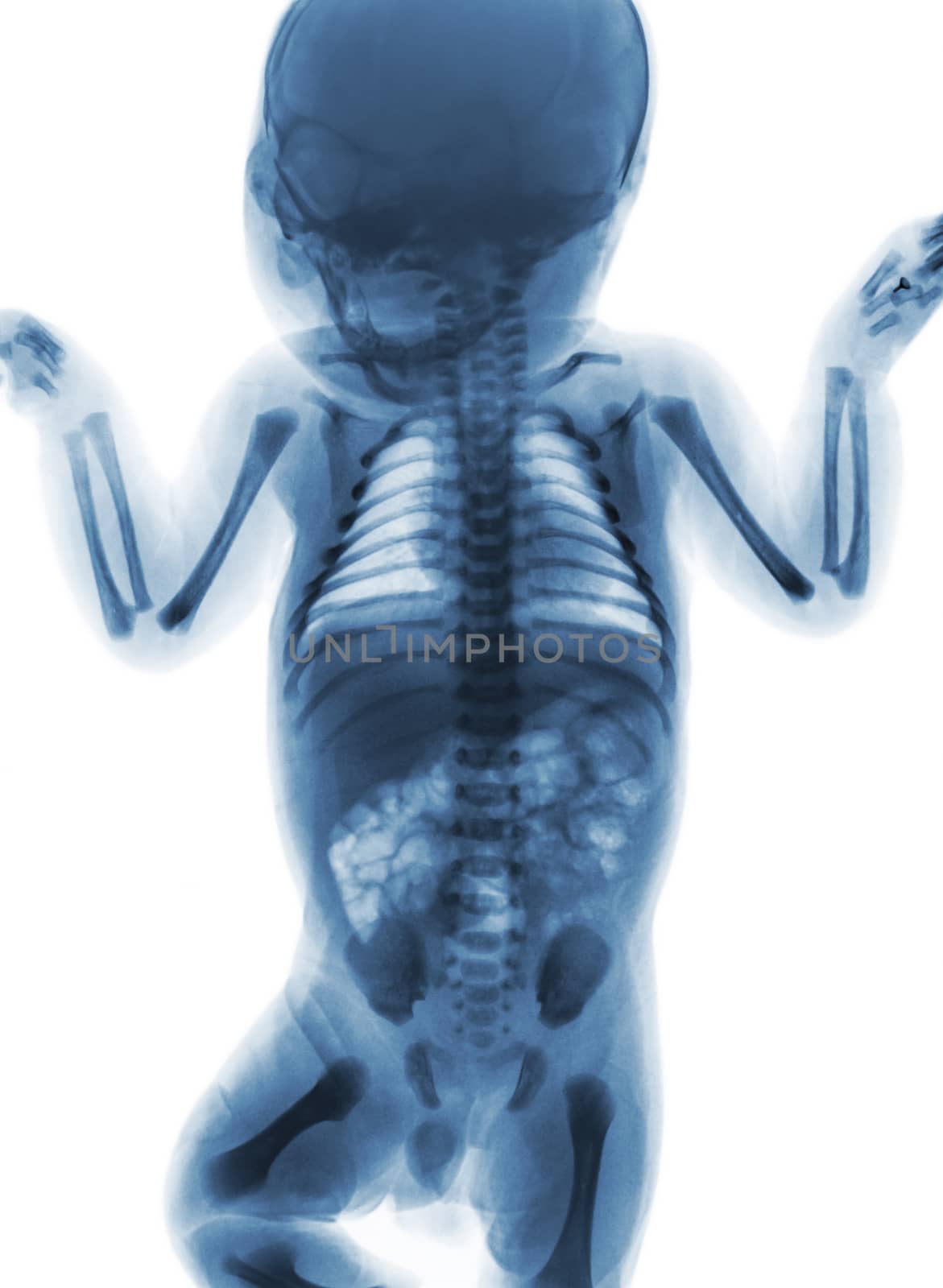 Film x-ray whole body of normal infant . front view .