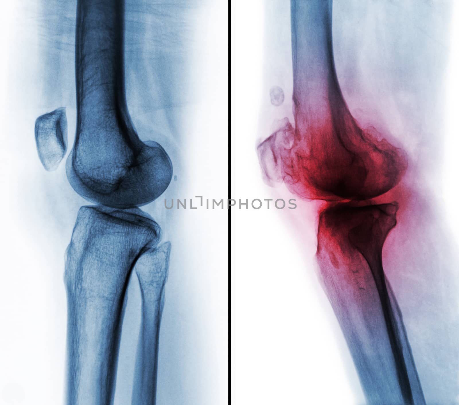 Comparison between normal human knee ( left image ) and osteoarthritis knee ( right image ) . Lateral view by stockdevil