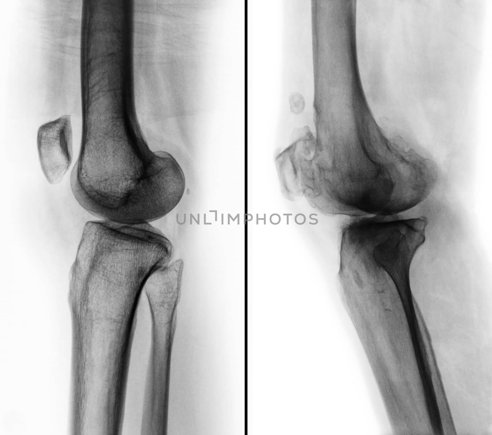 Comparison between normal human knee ( left image ) and osteoarthritis knee ( right image ) . Lateral view by stockdevil