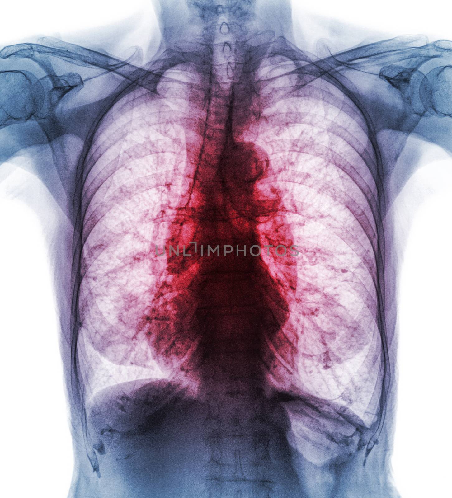 Pulmonary Tuberculosis . Film chest x-ray show interstitial infiltrate both lung due to Mycobacterium tuberculosis infection by stockdevil