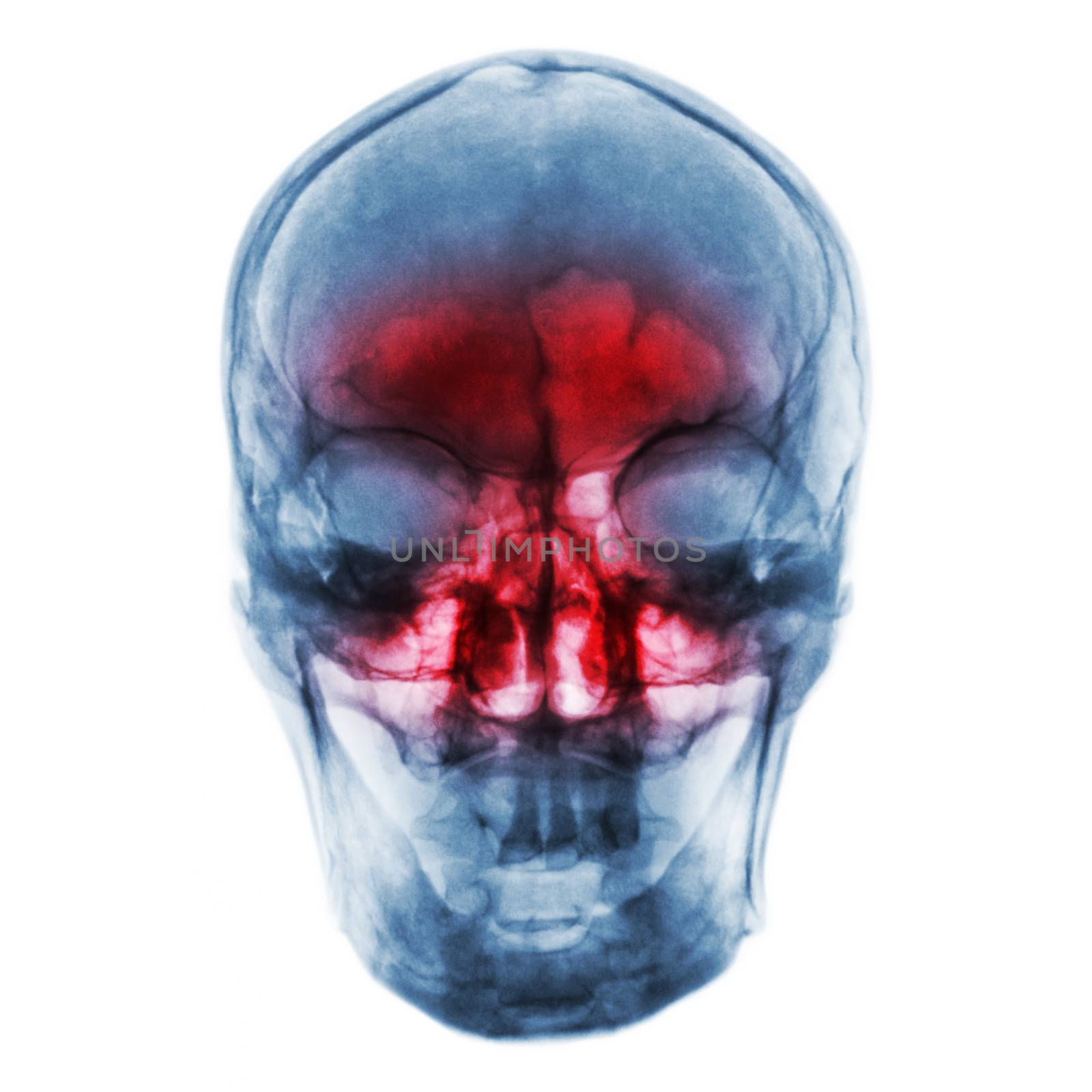 Sinusitis . Film x-ray of human skull with inflamed at sinus by stockdevil
