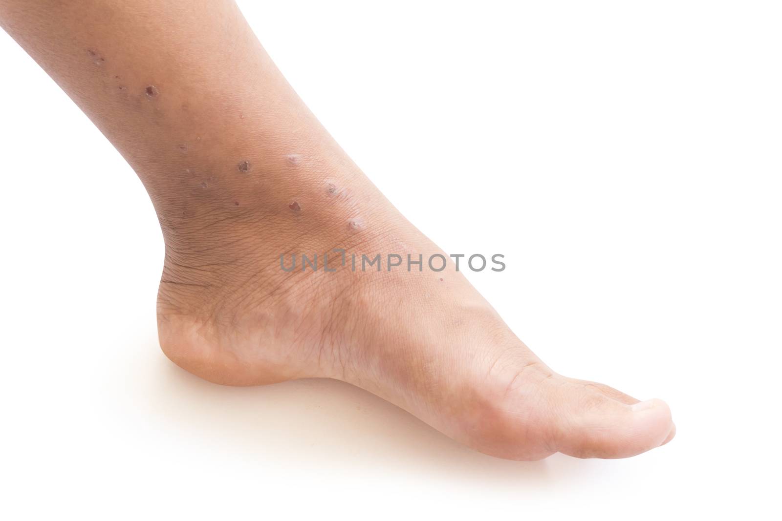 Woman leg with problematic skin and scars on white background, health care concept