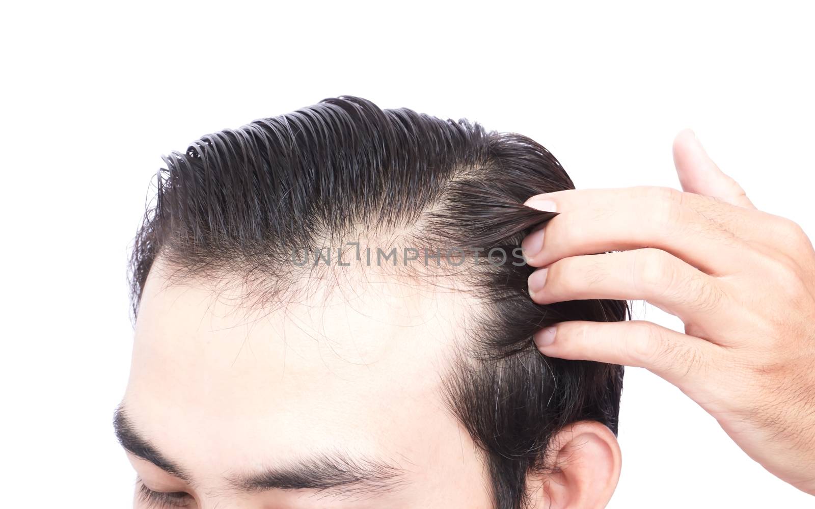 Young man serious hair loss problem for health care medical and shampoo product concept