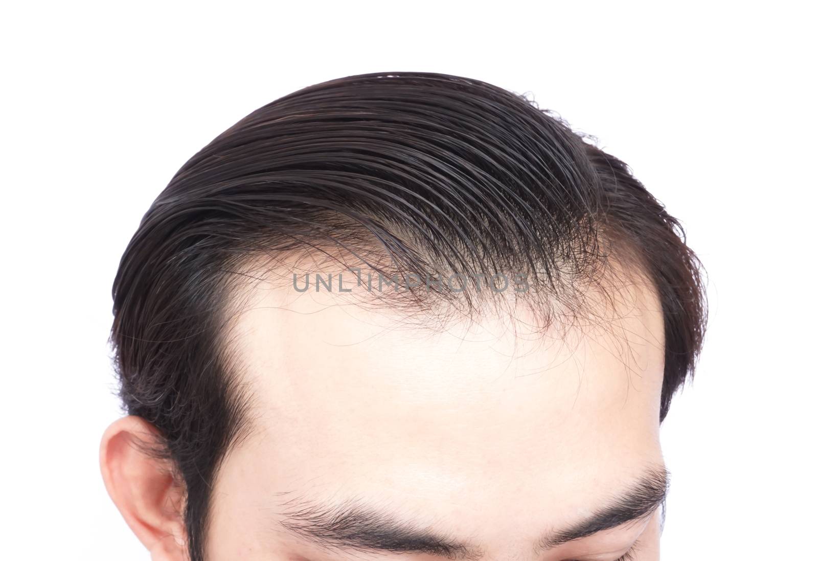 Young man serious hair loss problem for health care medical and  by pt.pongsak@gmail.com