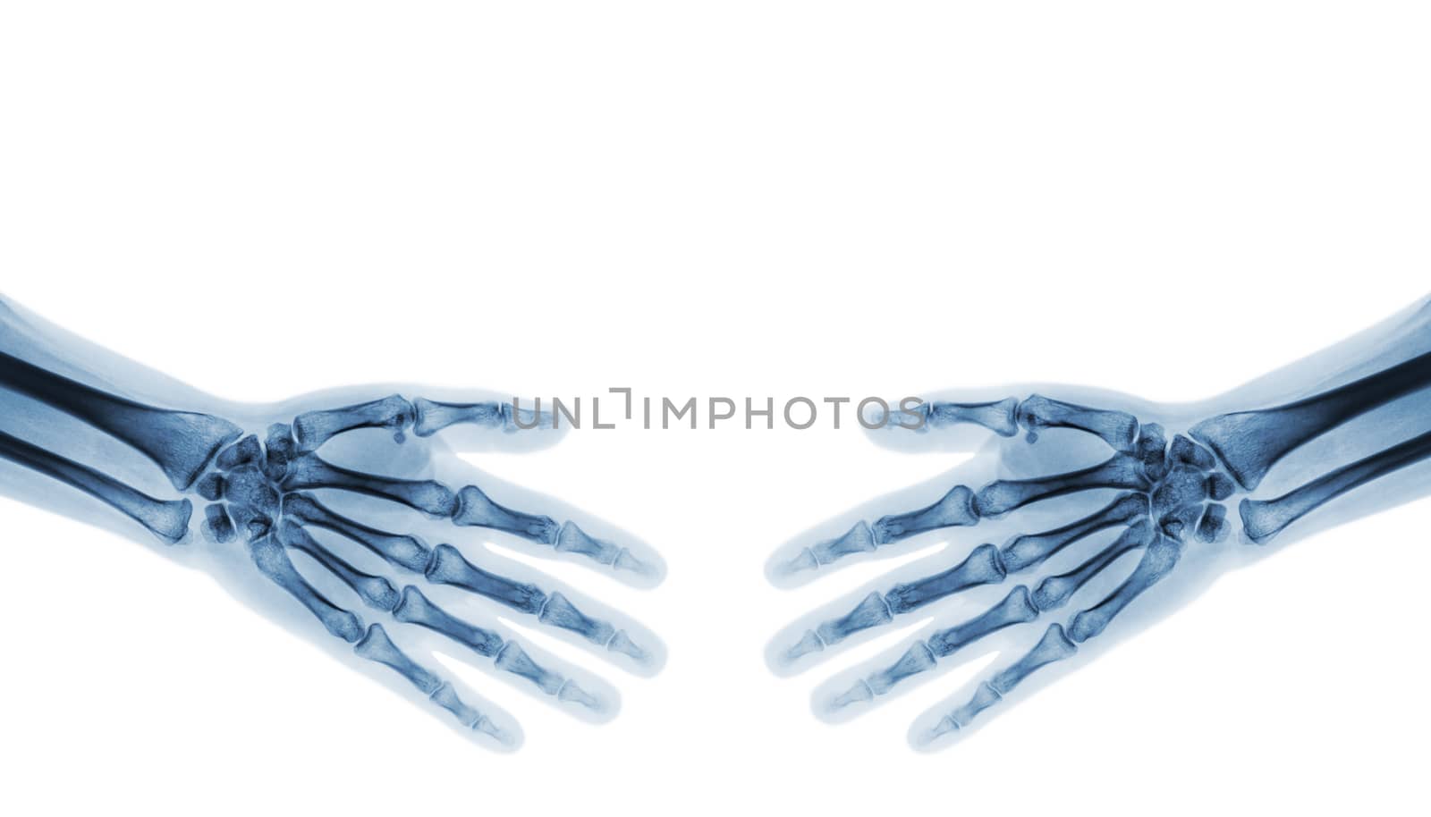 Shake hands . X-ray normal human hands ( blank area at upper side )