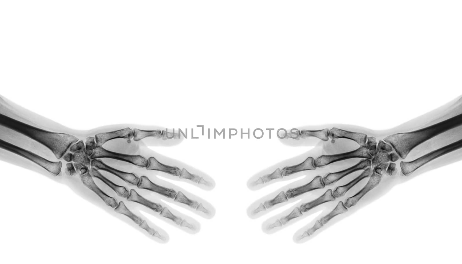 Shake hands . X-ray normal human hands by stockdevil