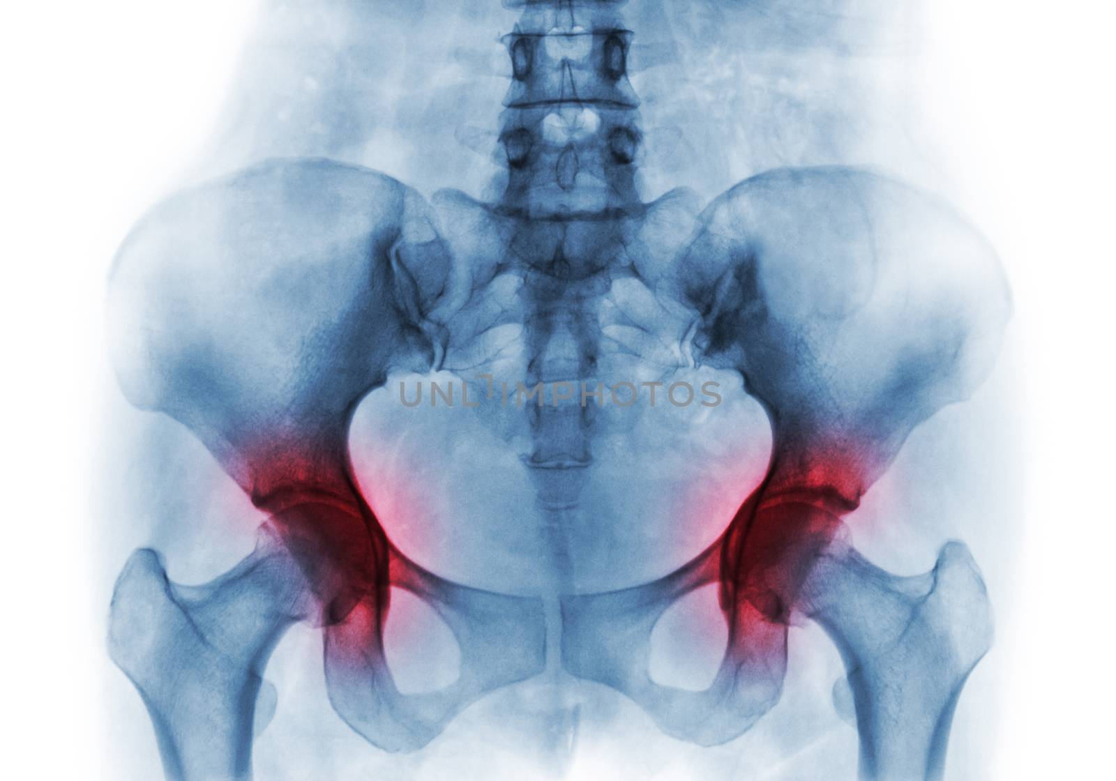 Arthritis both hip . Film x-ray of human pelvis by stockdevil