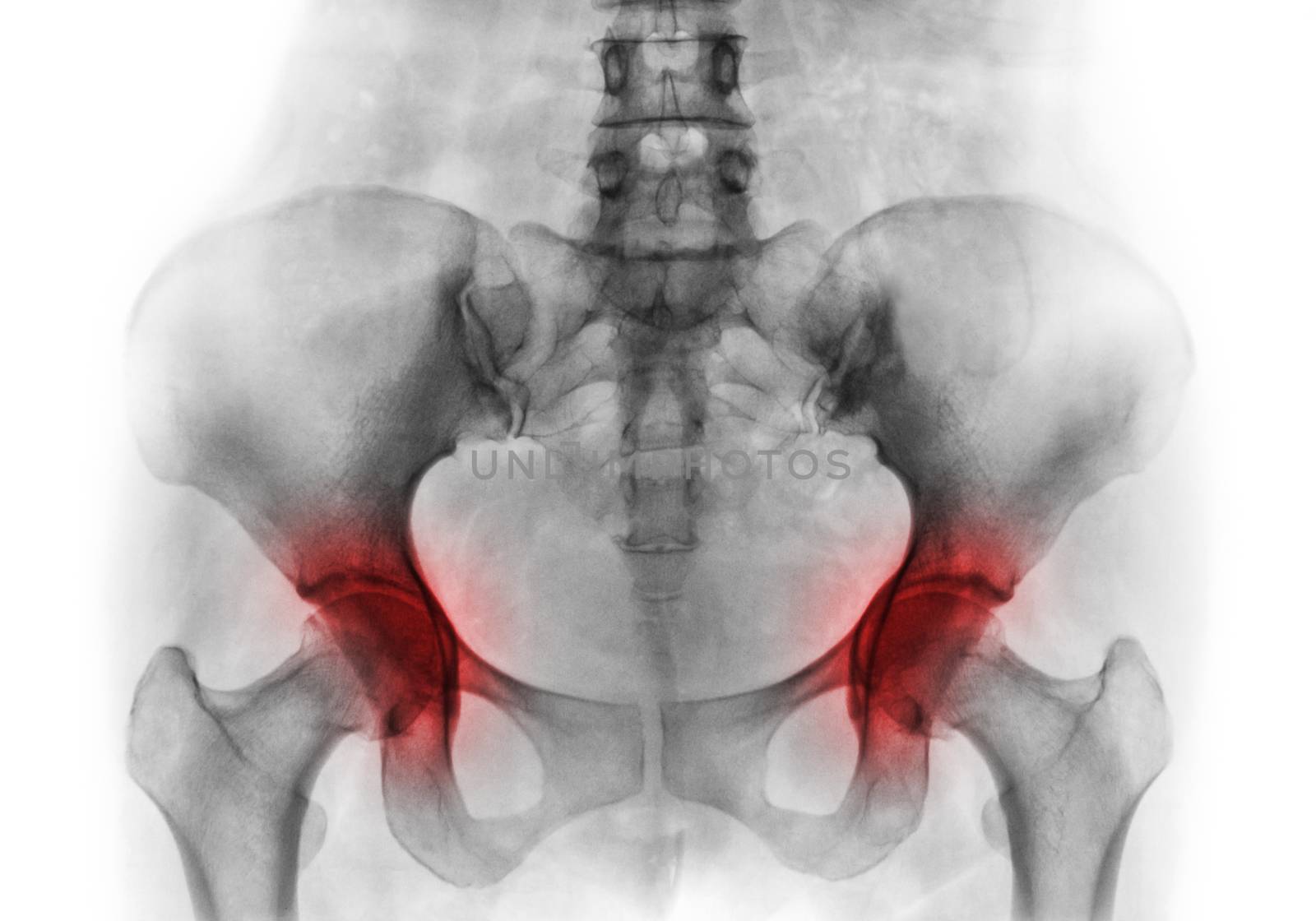 Arthritis both hip . Film x-ray of human pelvis by stockdevil