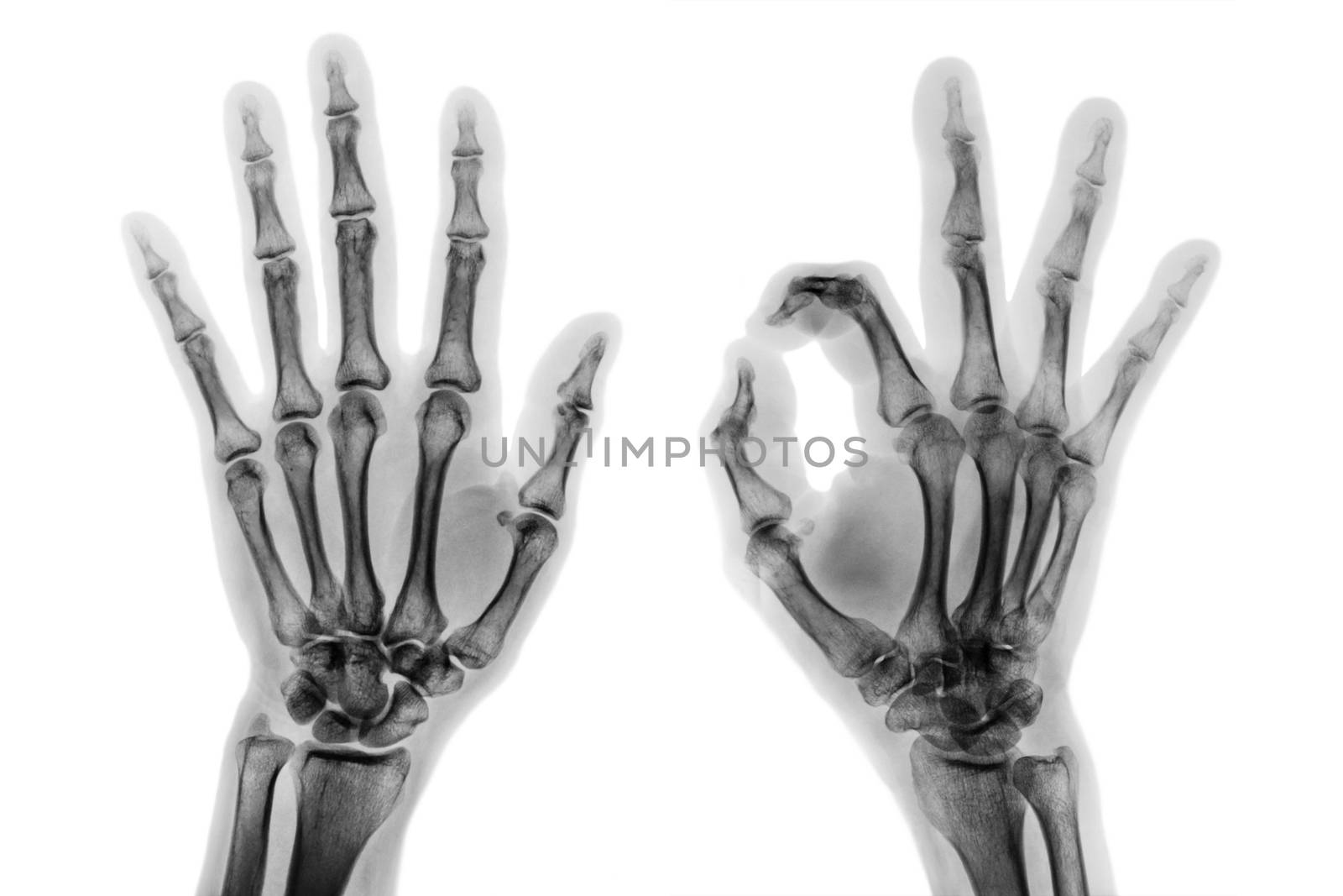 X - ray both hands with OK sign .