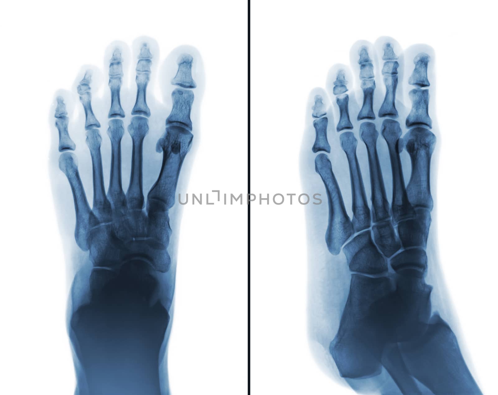 Film x-ray both normal human foots . 2 position ( front view and side view )