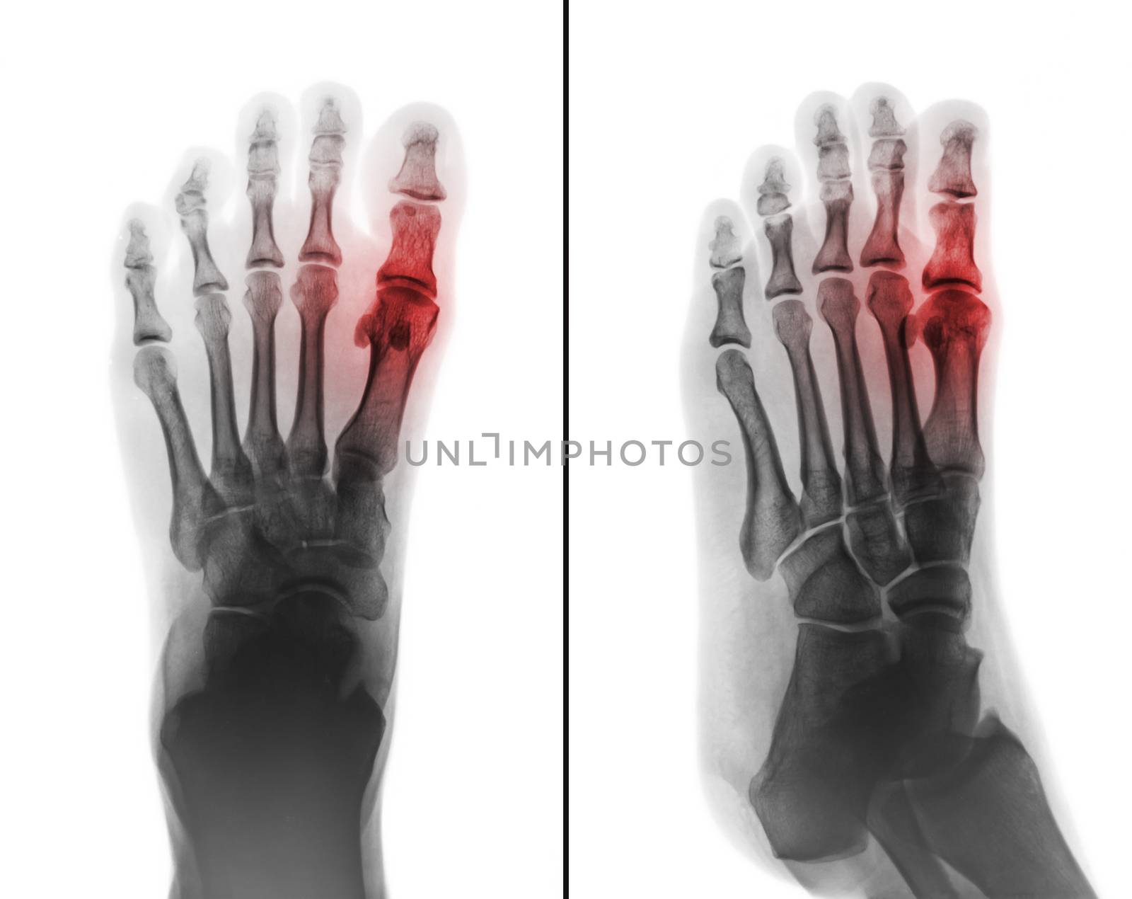 Gouty arthritis . film x-ray of human foot and arthritis at first metatarsophalangeal Joint . 2 position ( front and side view )