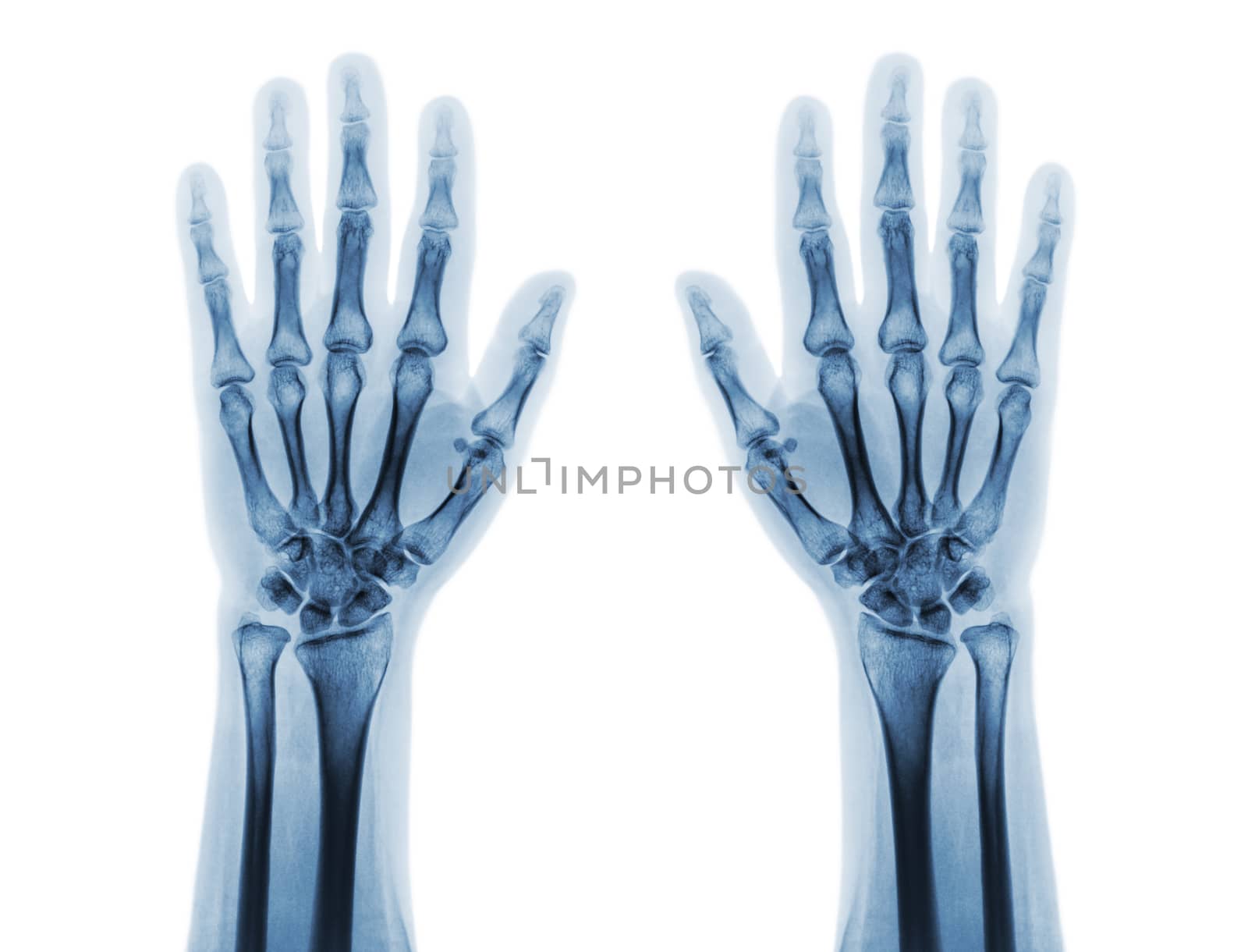 Film x-ray of both normal human hands . front view by stockdevil