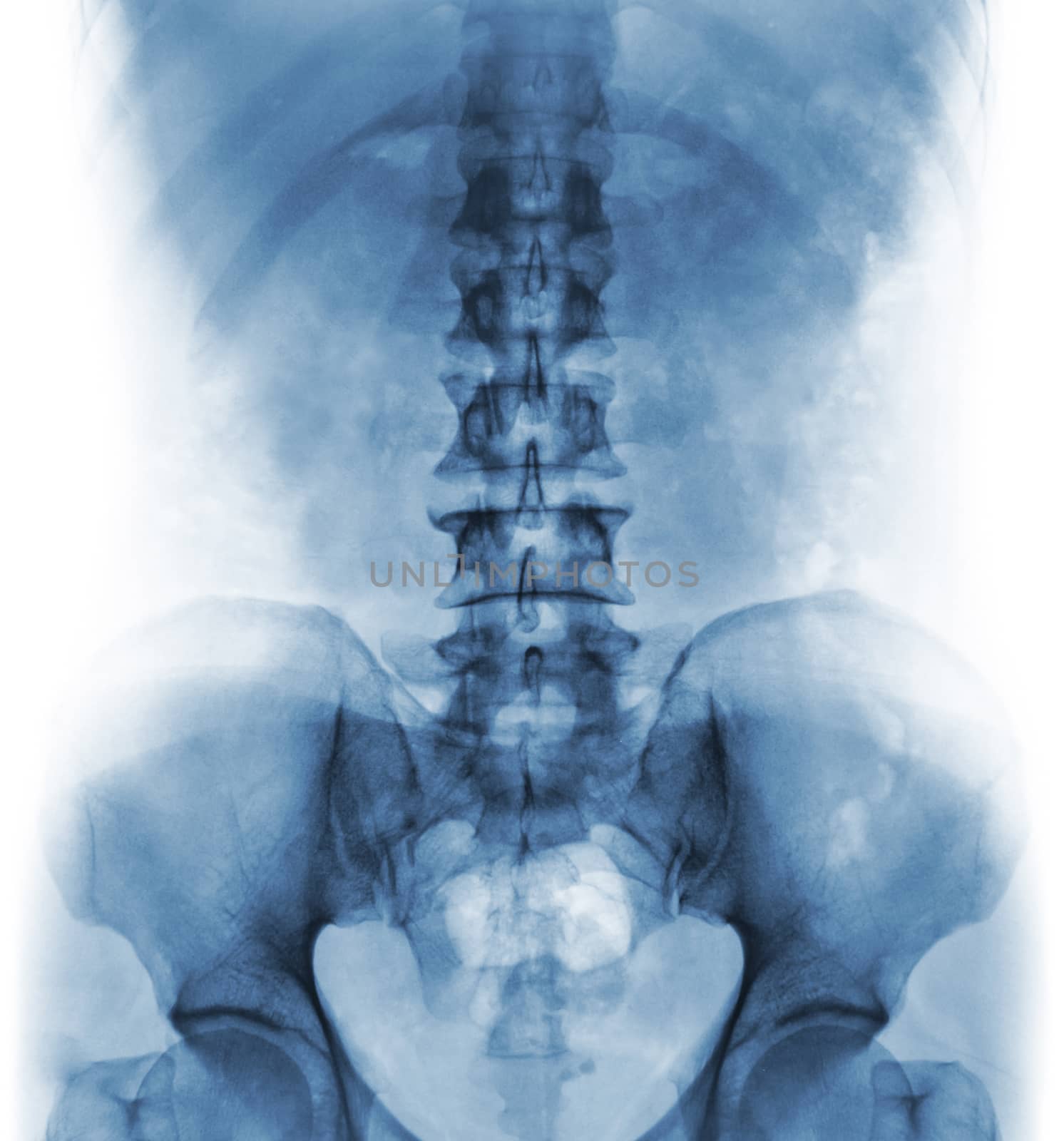 Film x-ray of normal human lumbar spine . by stockdevil