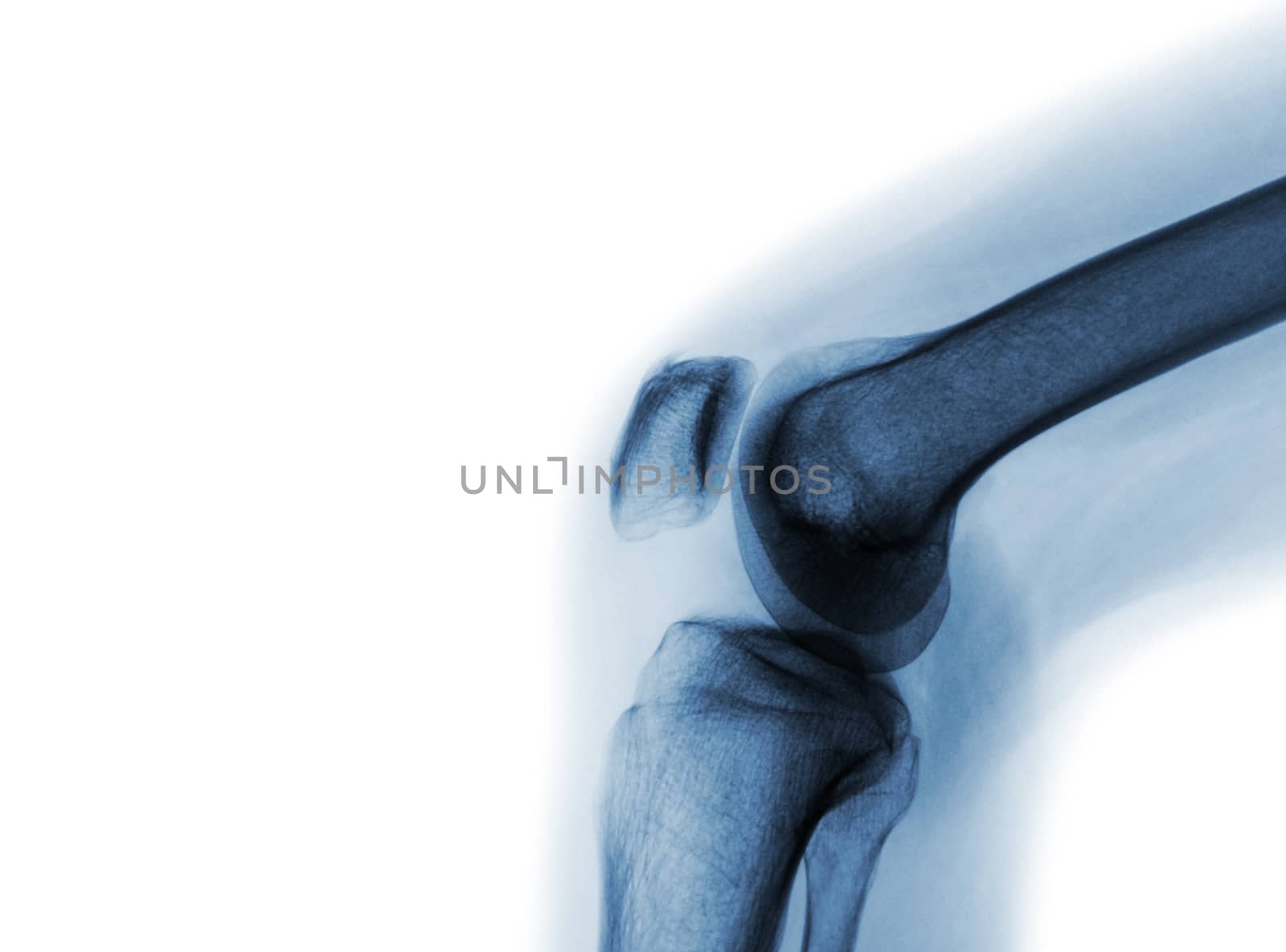 Film x-ray of normal knee joint by stockdevil