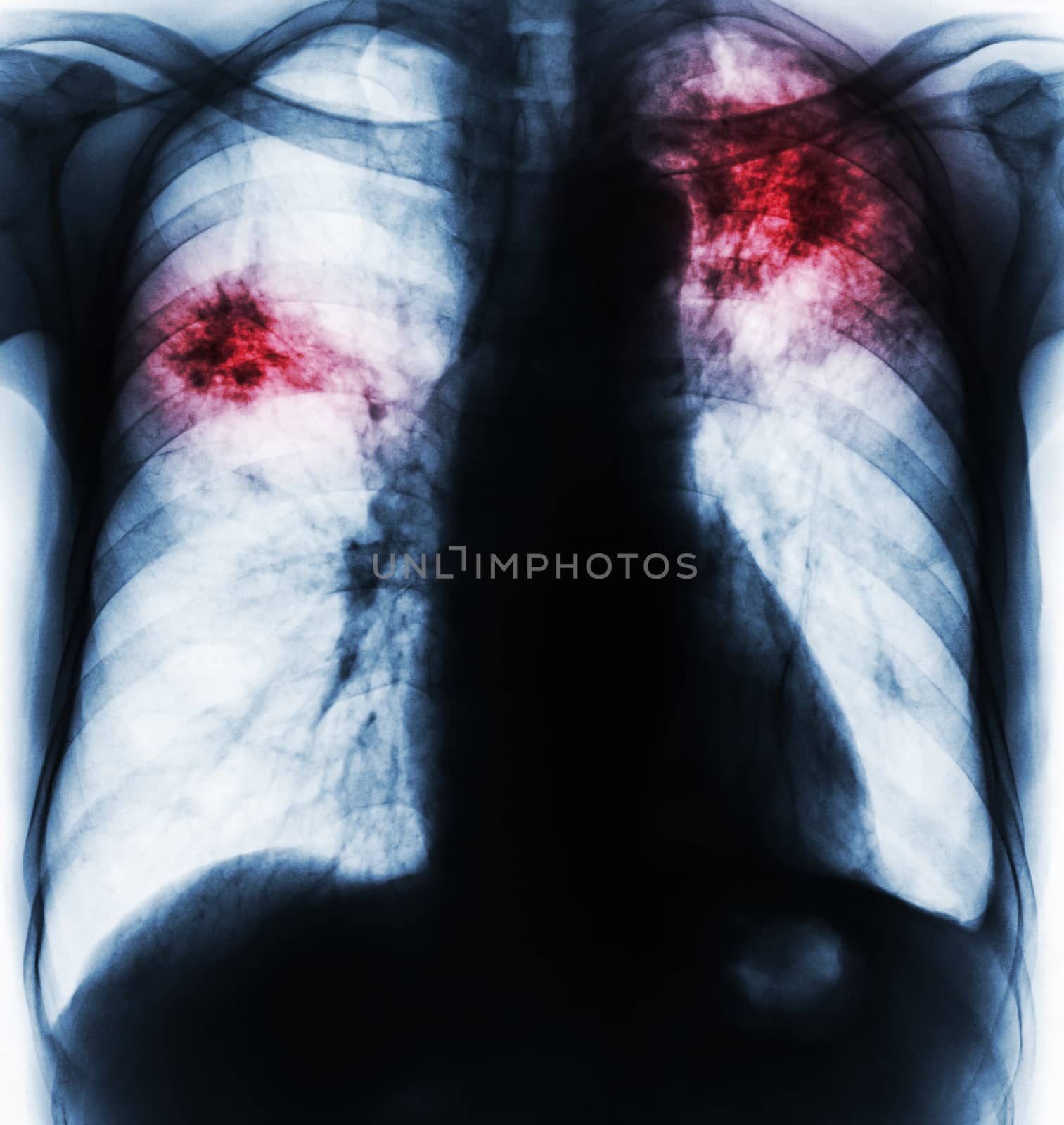 Pulmonary Tuberculosis . Film chest x-ray show fibrosis , interstitial infiltration both lung due to Mycobacterium tuberculosis infection .