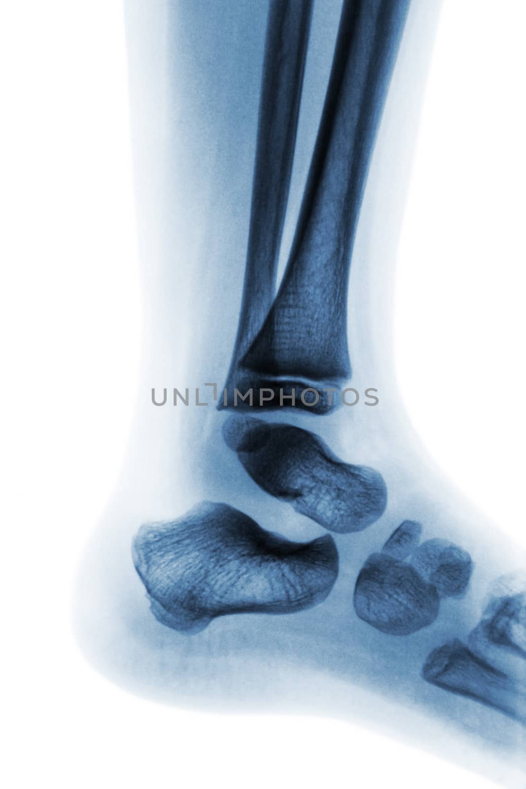 Film x-ray of normal child ankle . Lateral view by stockdevil