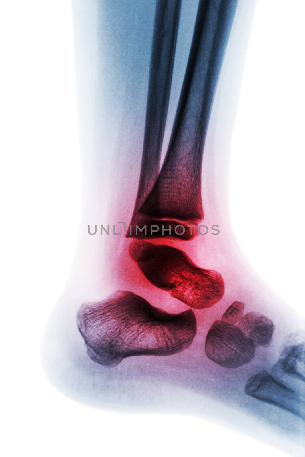 Arthritis of ankle ( Juvenile rheumatoid ) . by stockdevil