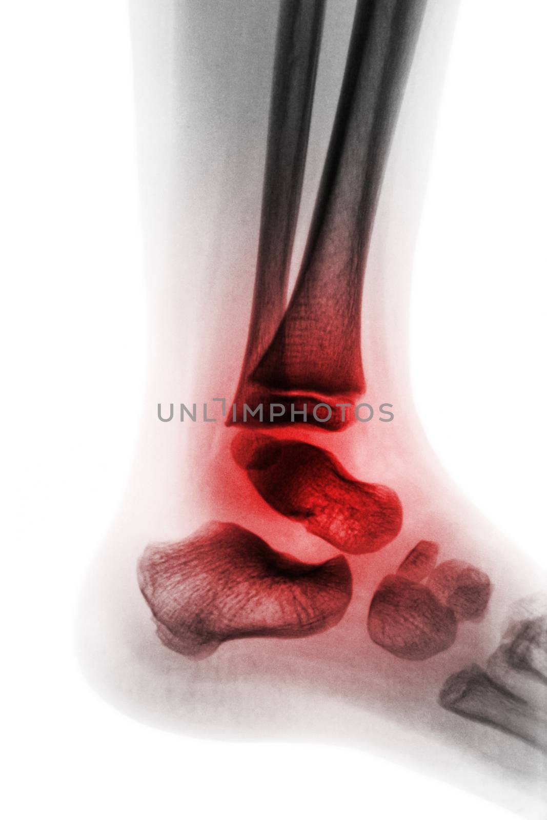 Arthritis of ankle . X-ray of child ankle and inflame joint . Lateral view . ( Concept of Juvenile rheumatoid )