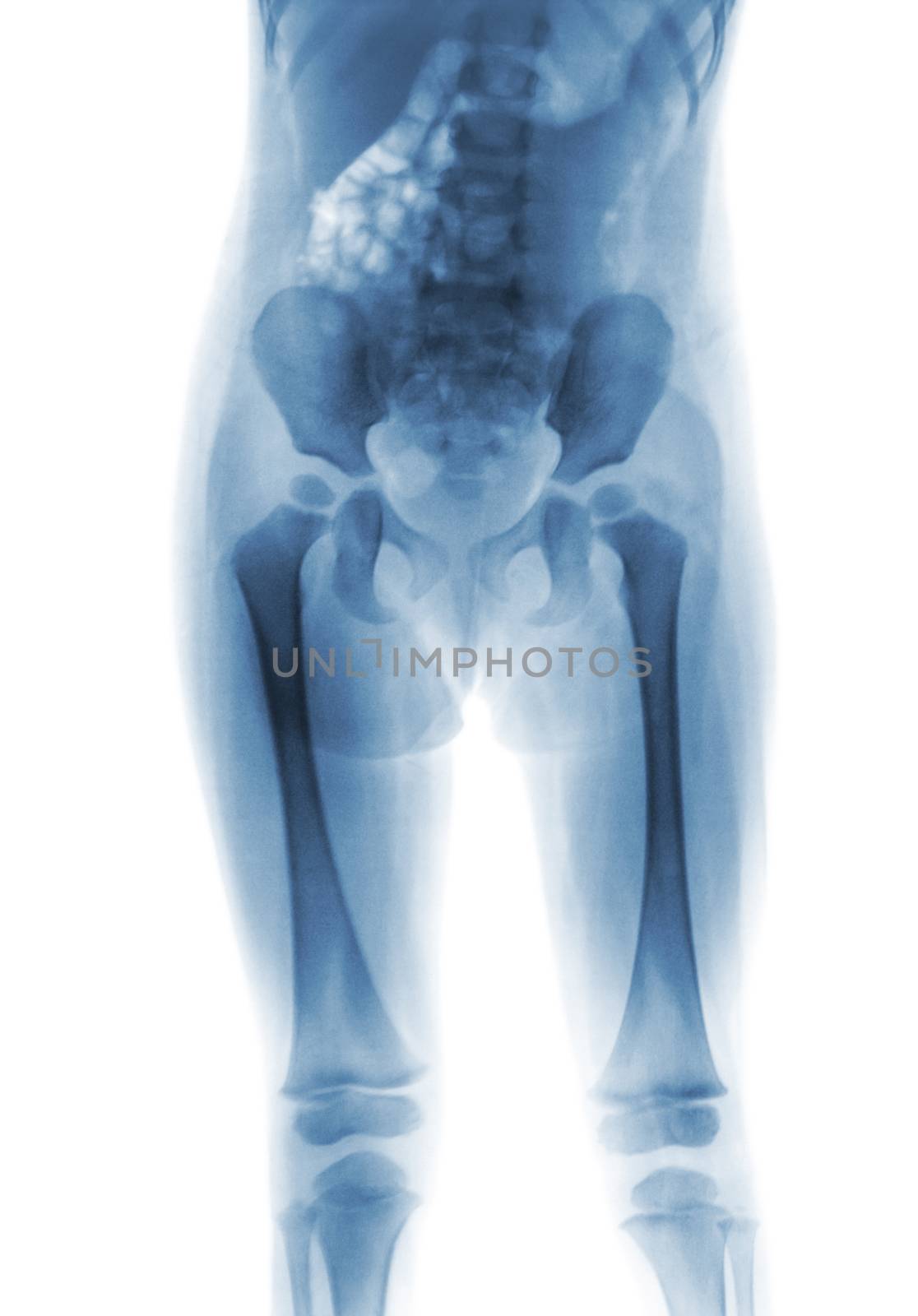 Film x-ray normal body of child ( Lower half of body )