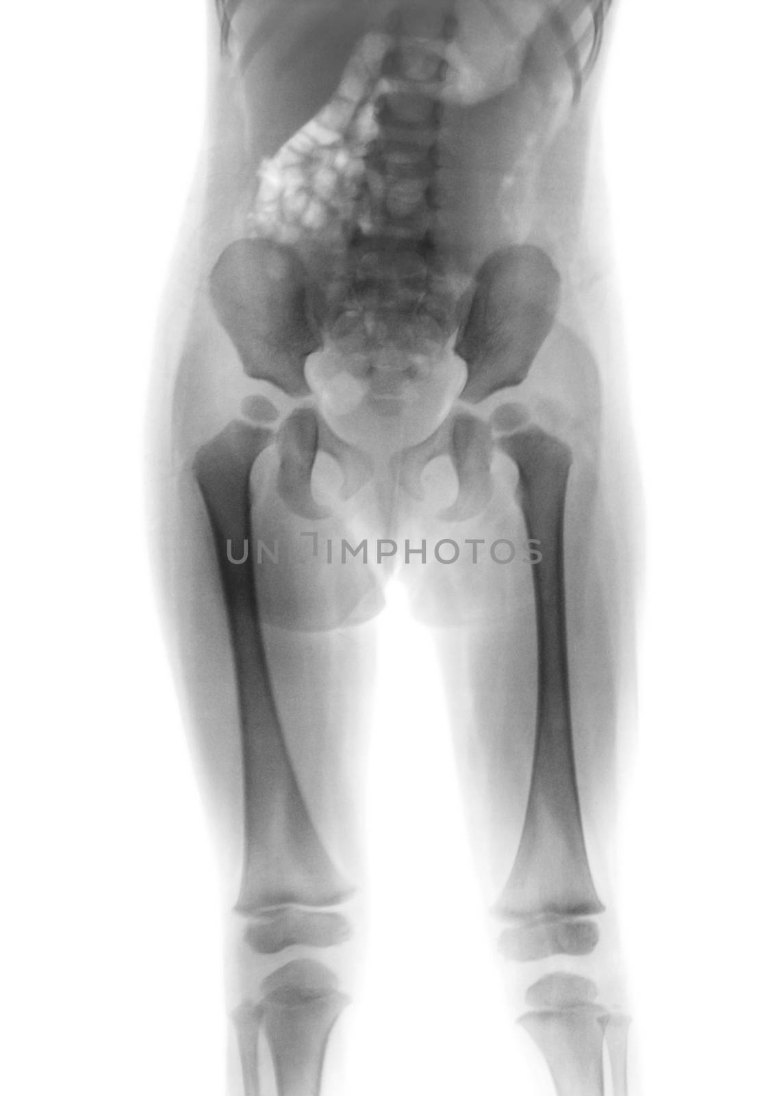 Film x-ray body of child ( Lower half of body ) by stockdevil
